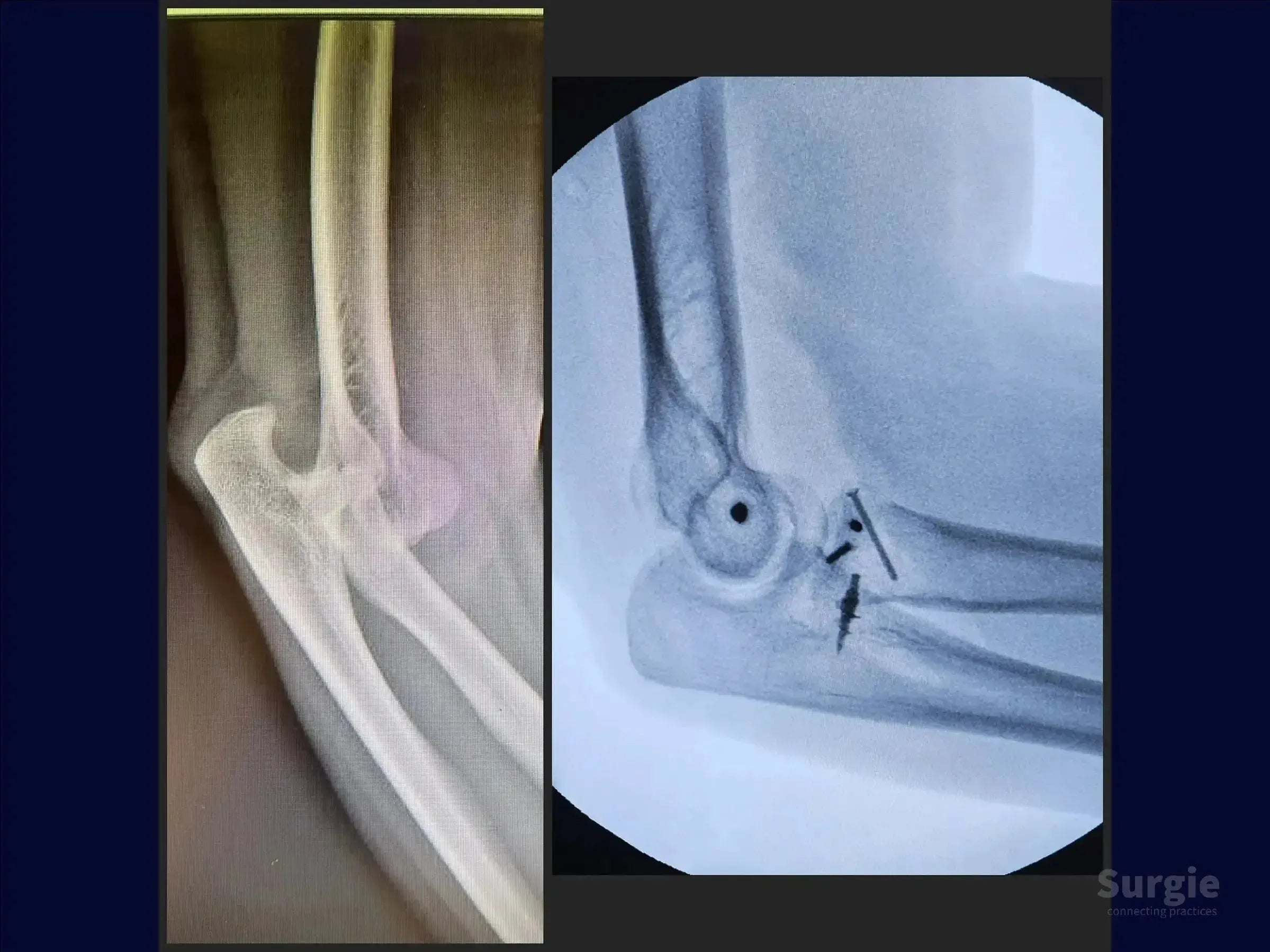 Side-by-side elbow X-rays showing a comminuted radial head fracture before and after surgical fixation with metal implants.