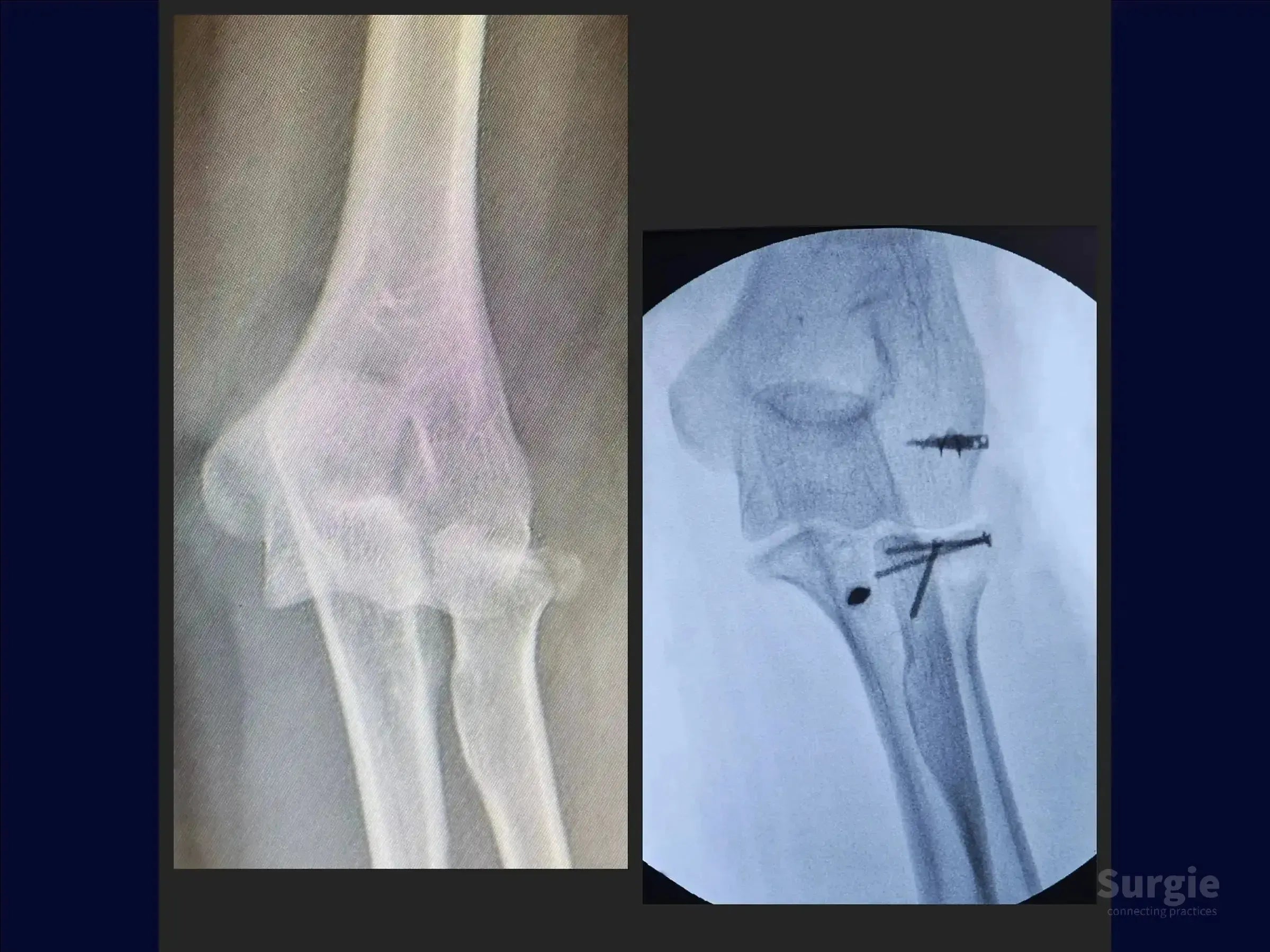 Elbow X-ray showing pre-operative injury and post-operative fixation with screws for a terrible triad fracture.