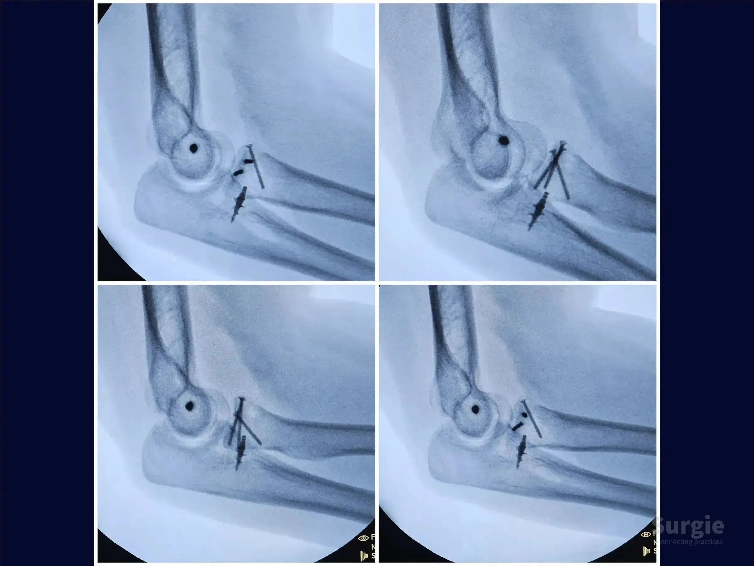 Four X-ray views showing surgical fixation of a terrible triad elbow injury with metallic screws and anchors.