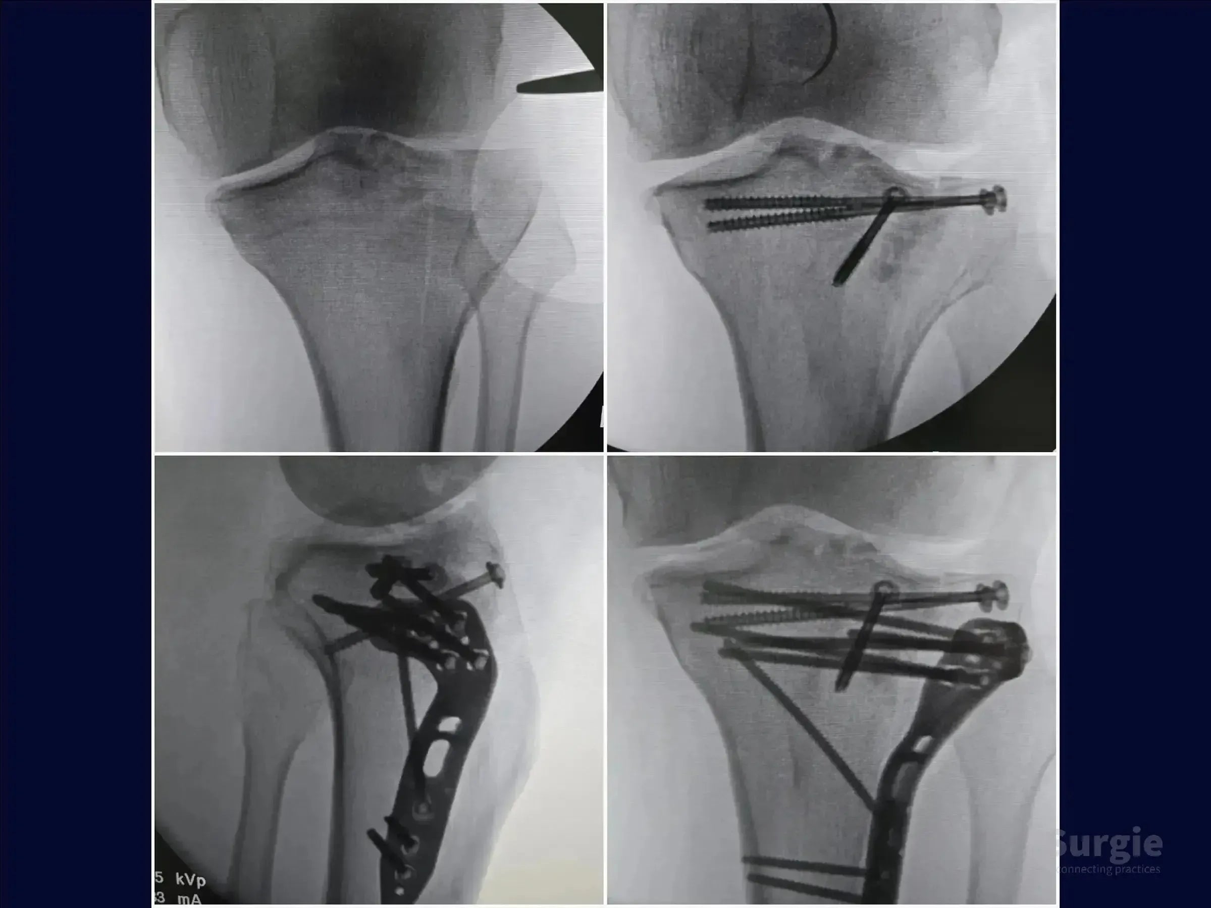 Fluoroscopic X-ray sequence of tibial plateau fracture repair using cannulated screws and a lateral locking plate.