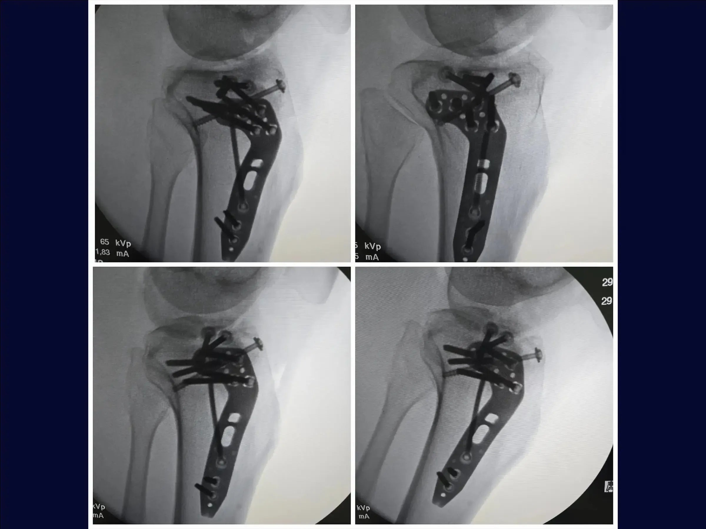 Schienbeinkopfbruch mit zentraler Impression (anterolateraler Zugang und inkomplette Osteotomie)