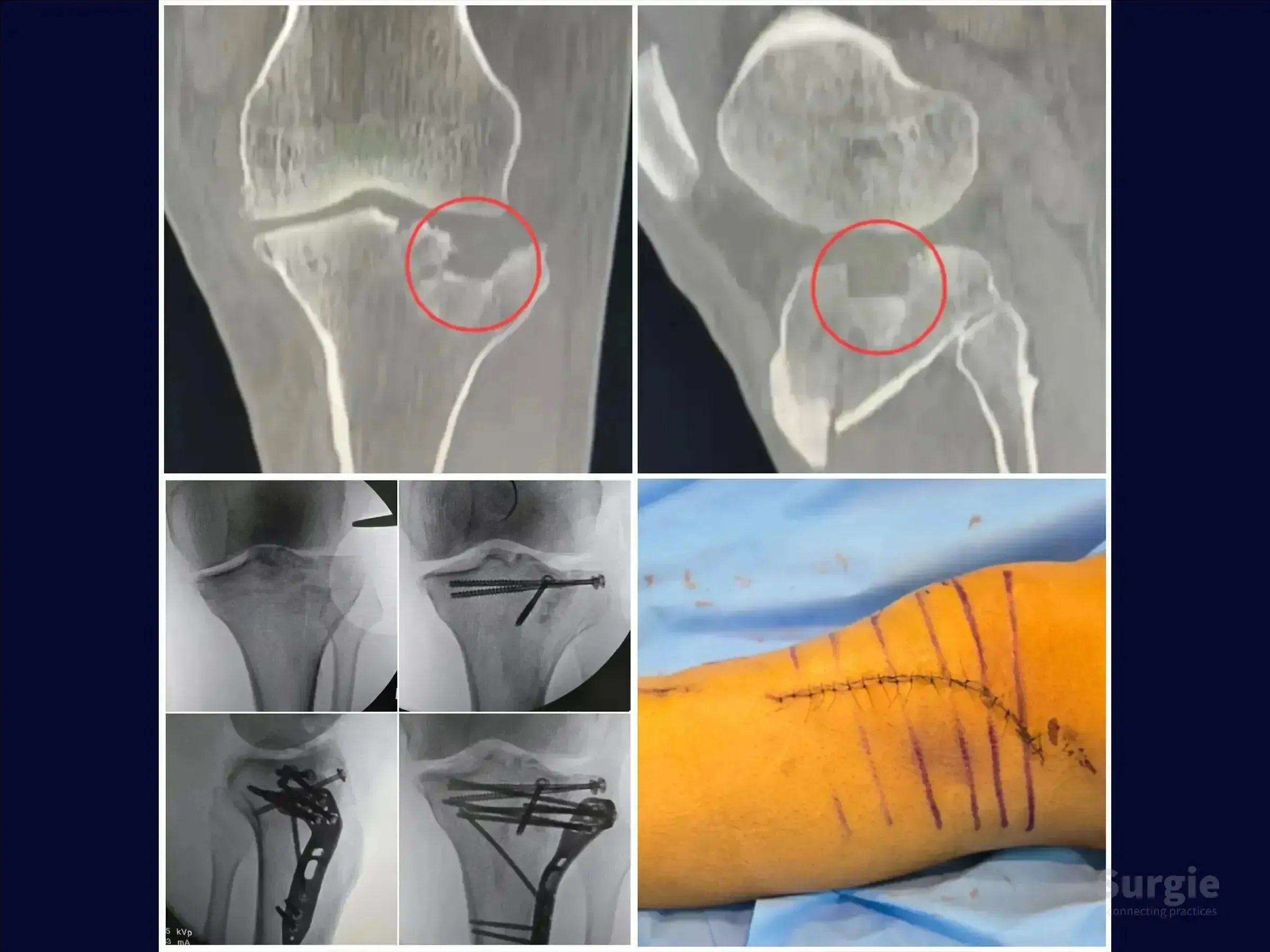 CT scans and X-rays showing tibial plateau fracture repair with screws, plate, and a hockey stick surgical incision.