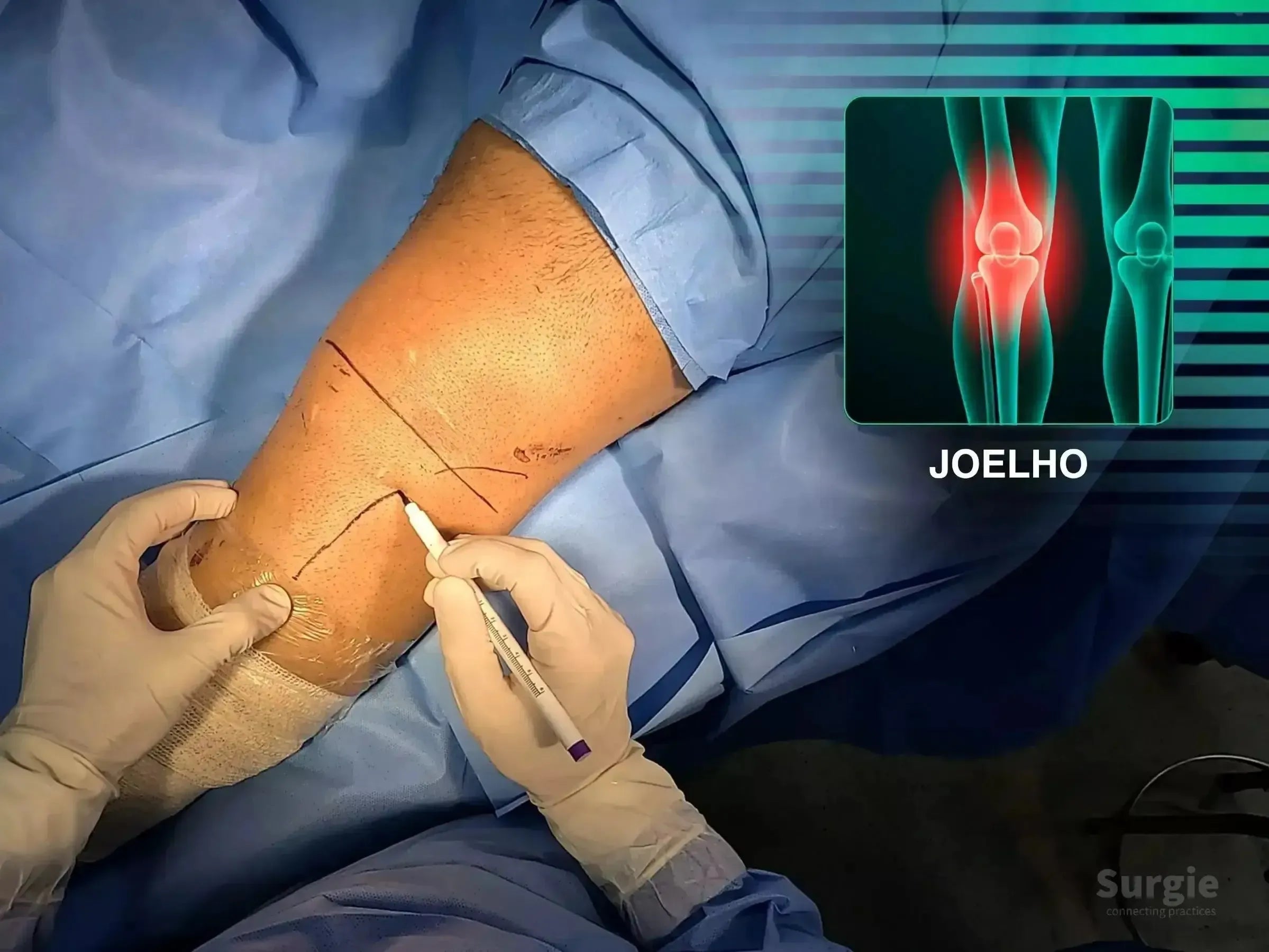 Surgeon marking a hockey stick incision on a knee for tibial plateau fracture repair with an anatomical overlay.