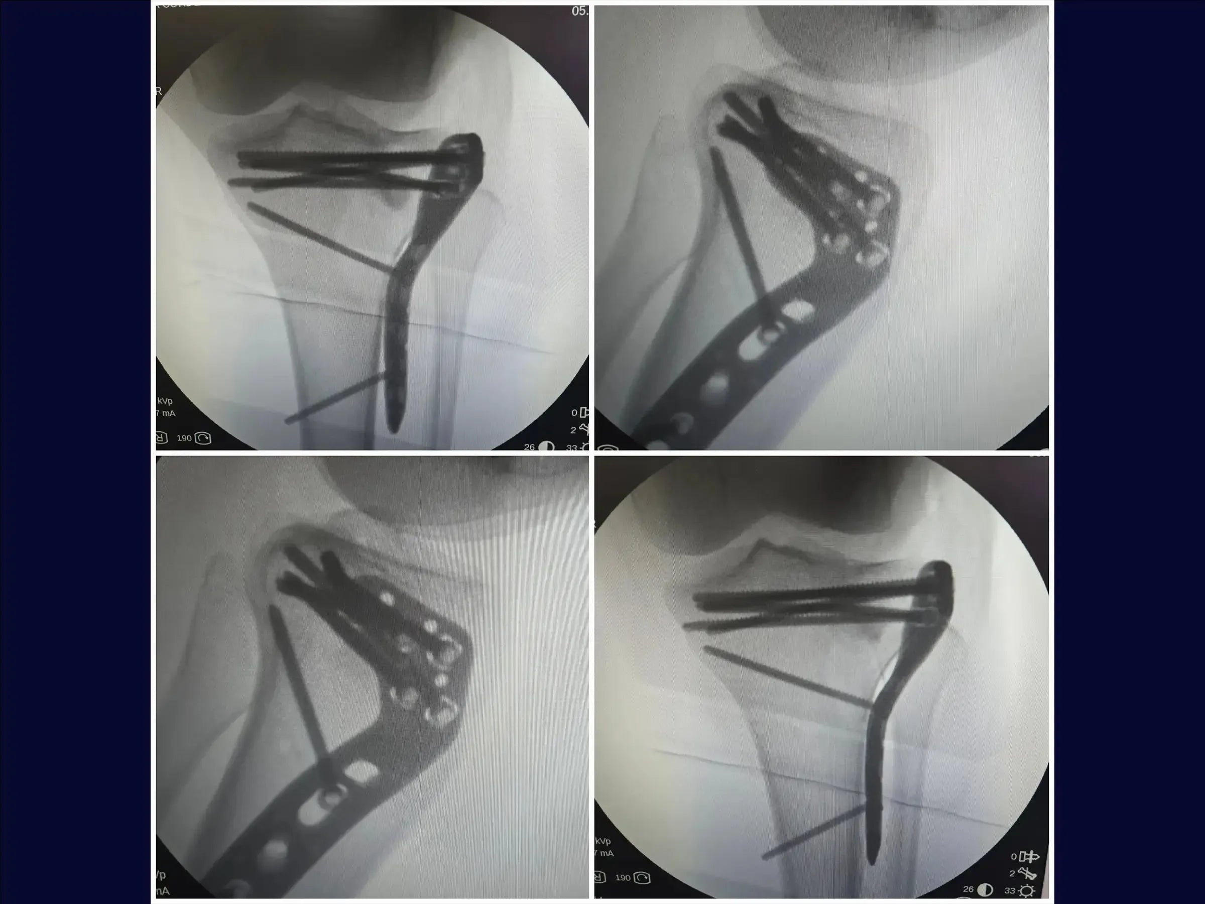 Tibiakopffraktur mit zentraler Depression und inkompletter Osteotomie