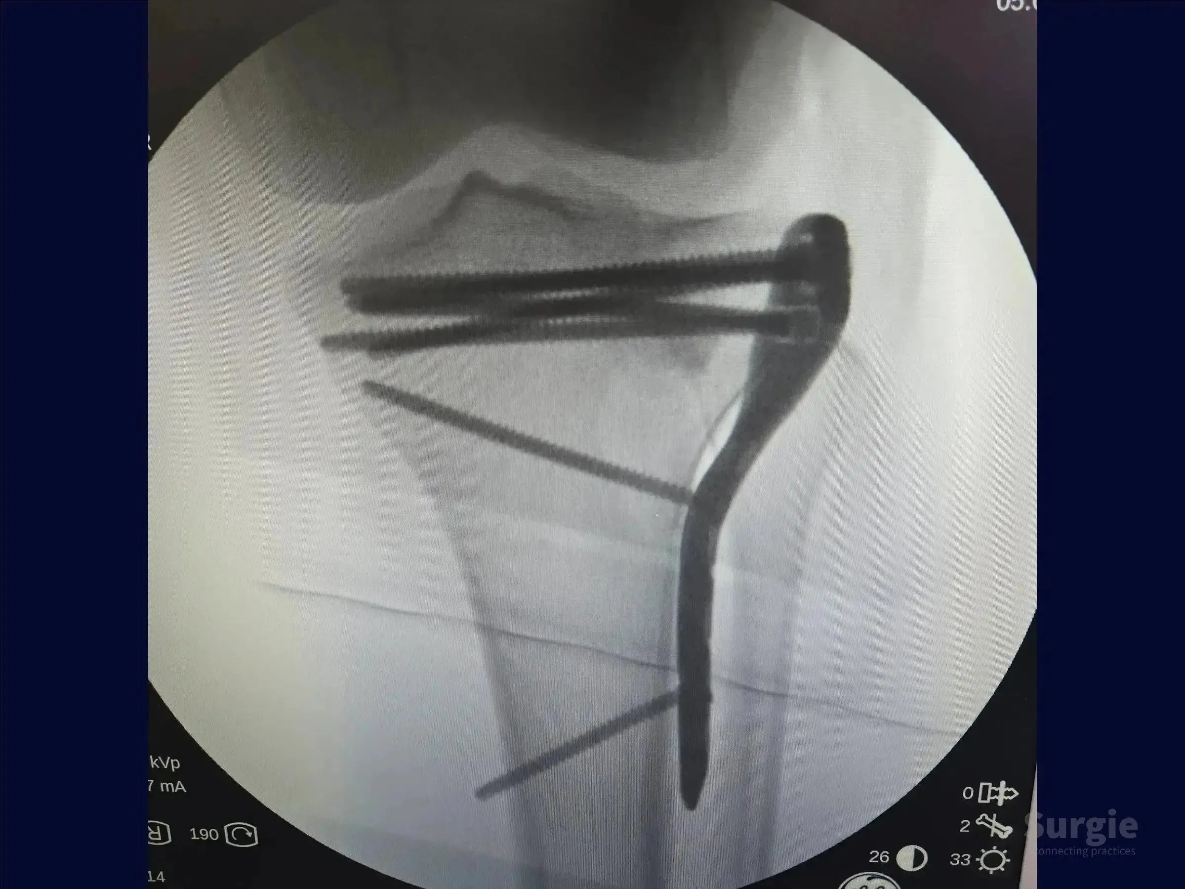 X-ray showing tibial plateau fracture fixation with a metal plate and multiple screws for anatomical stabilization.