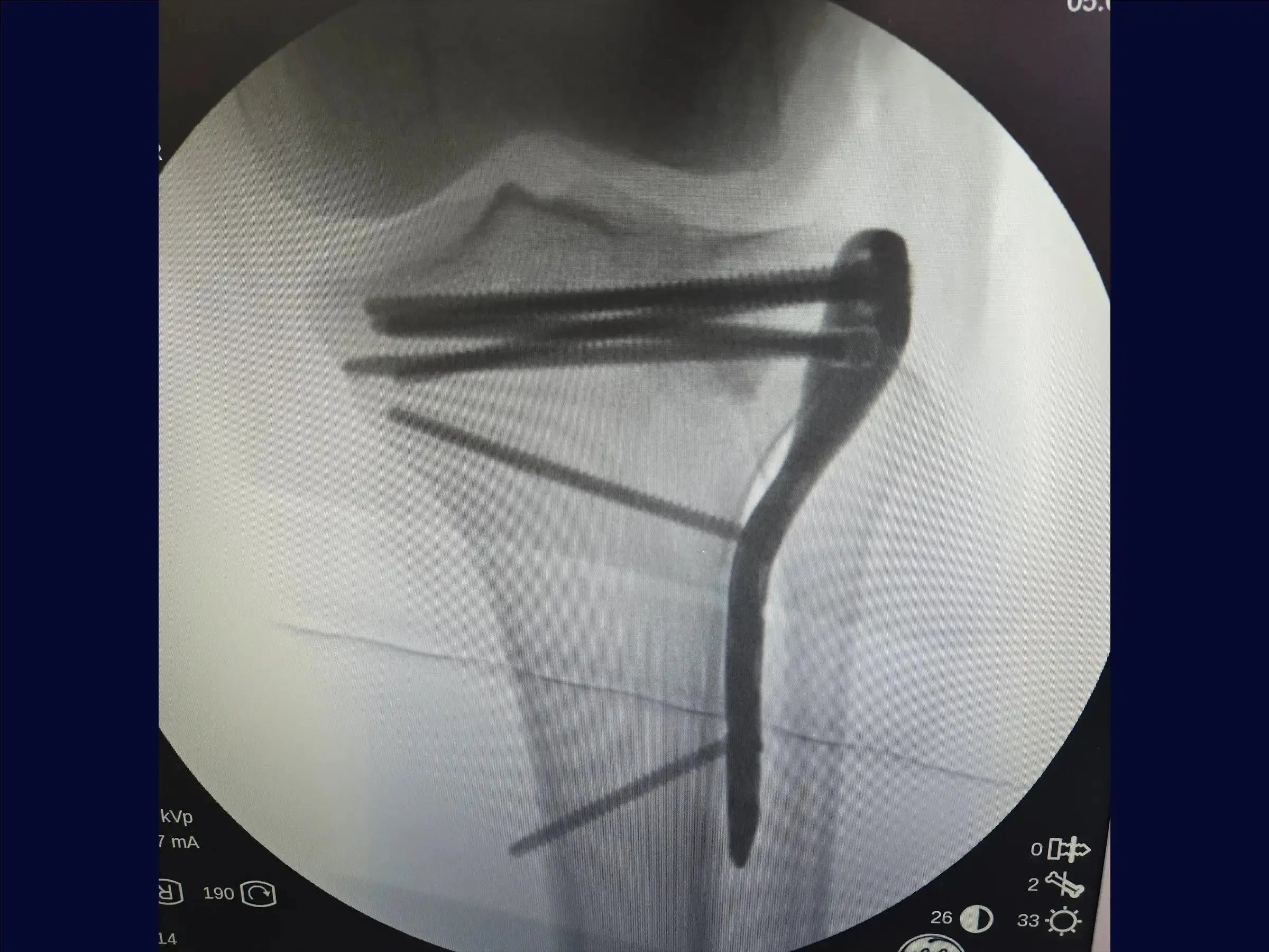 Tibiakopffraktur mit zentraler Depression und inkompletter Osteotomie