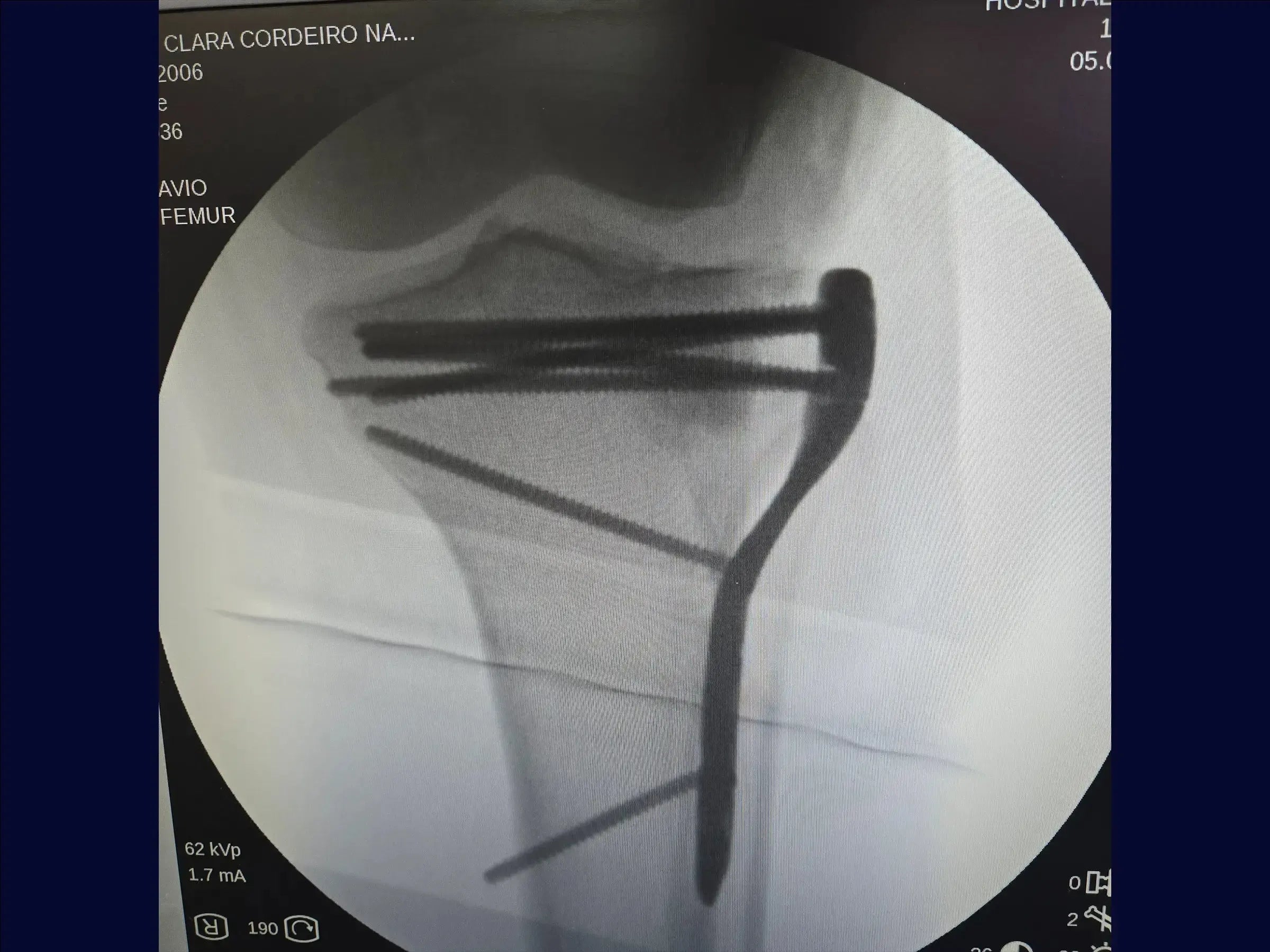 Tibiakopffraktur mit zentraler Depression und inkompletter Osteotomie