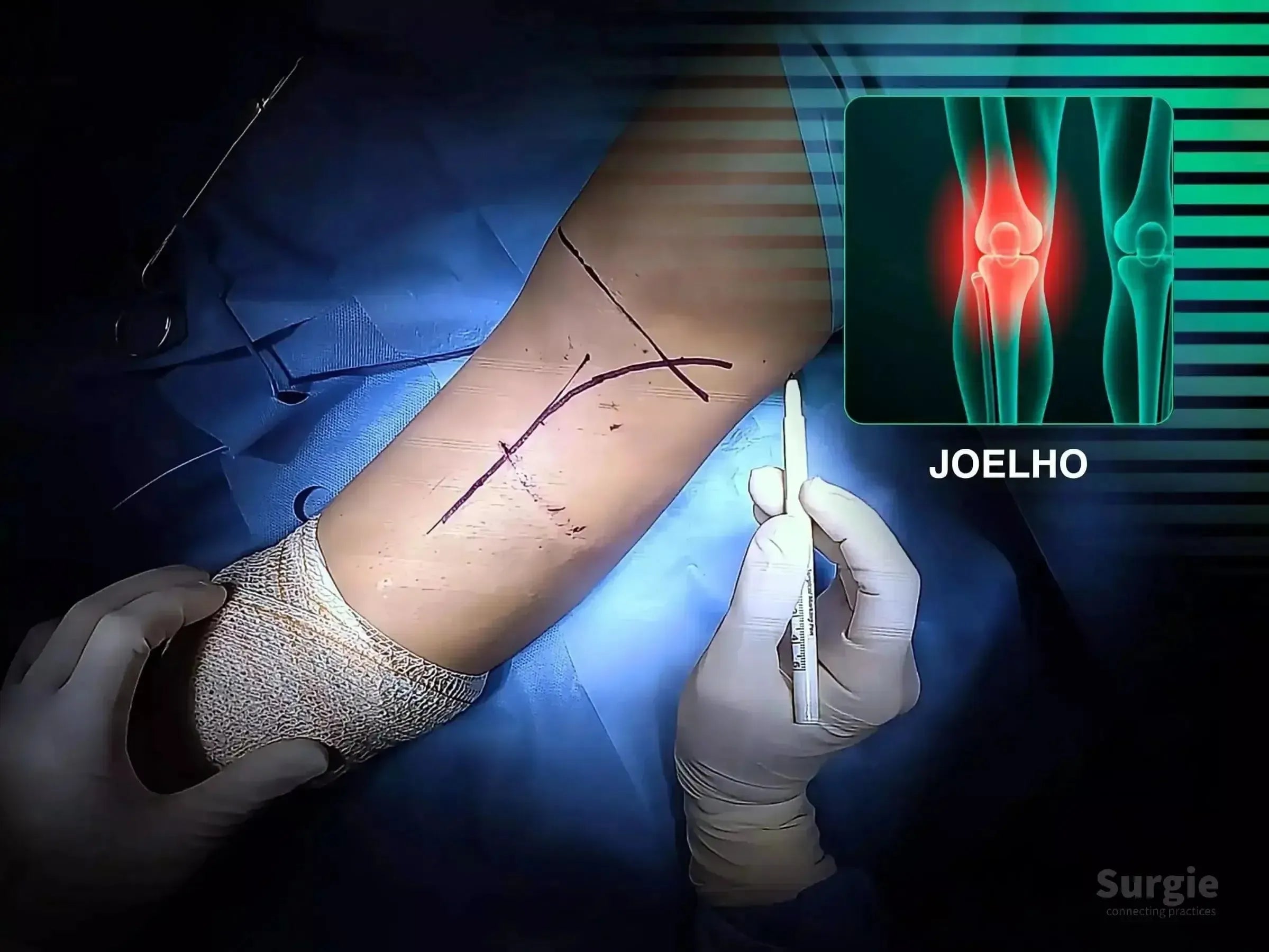 Surgeon marking a hockey stick incision on a knee for tibial plateau fracture repair with a digital knee anatomy overlay.