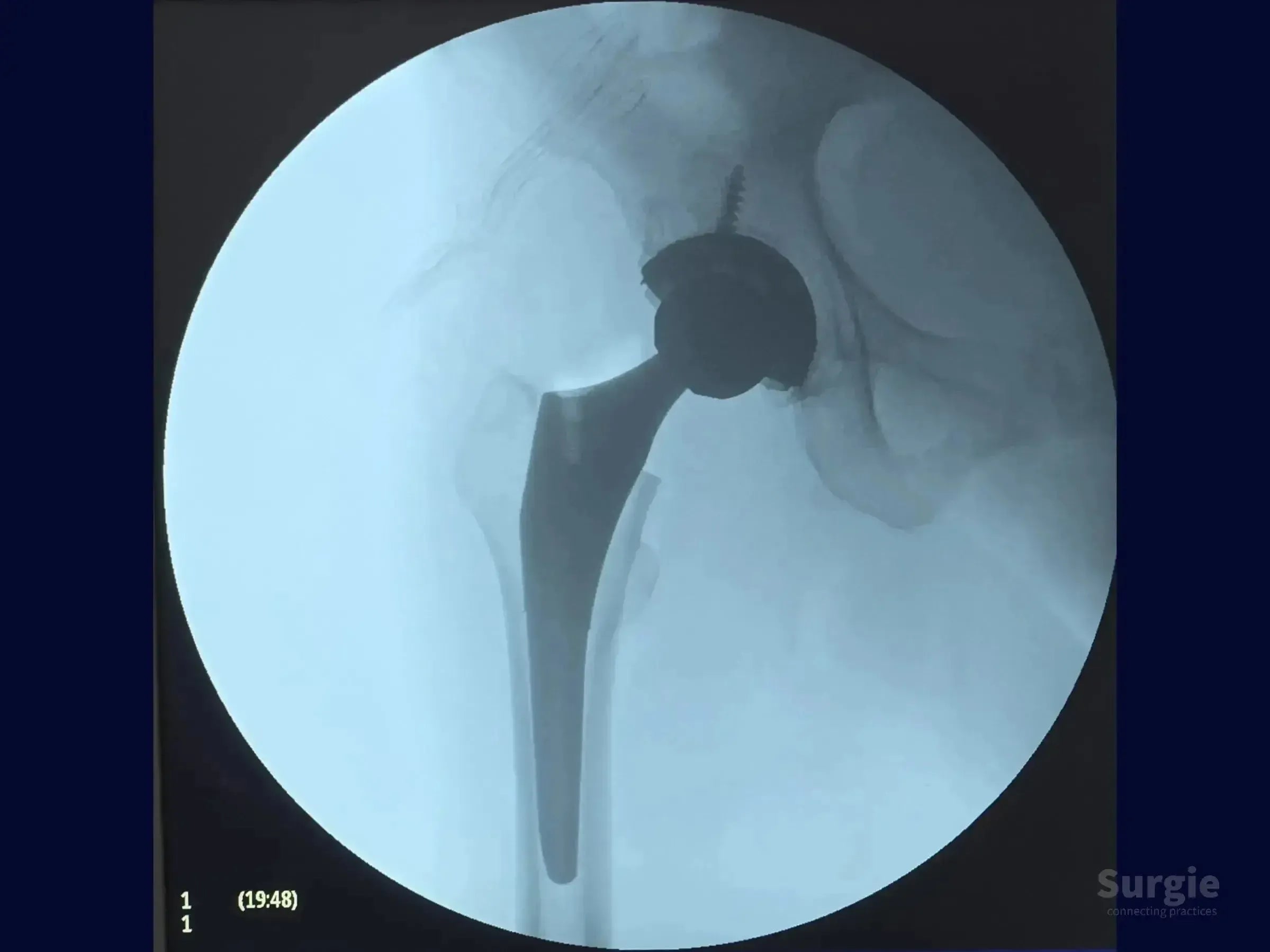 X-ray of a total hip arthroplasty featuring an uncemented femoral stem and a press-fit acetabular cup with screw fixation.