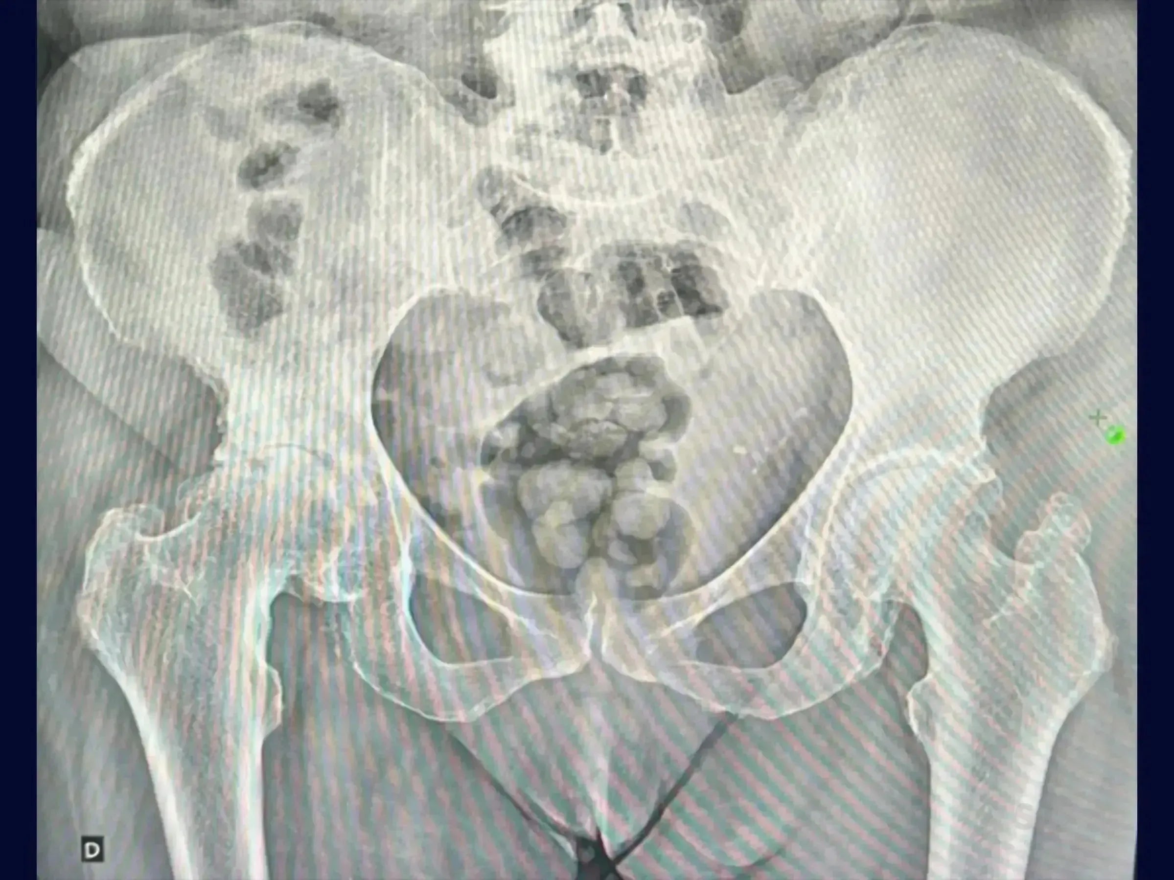 Pelvic X-ray showing bilateral hip joints with signs of coxarthrosis for total hip arthroplasty planning.