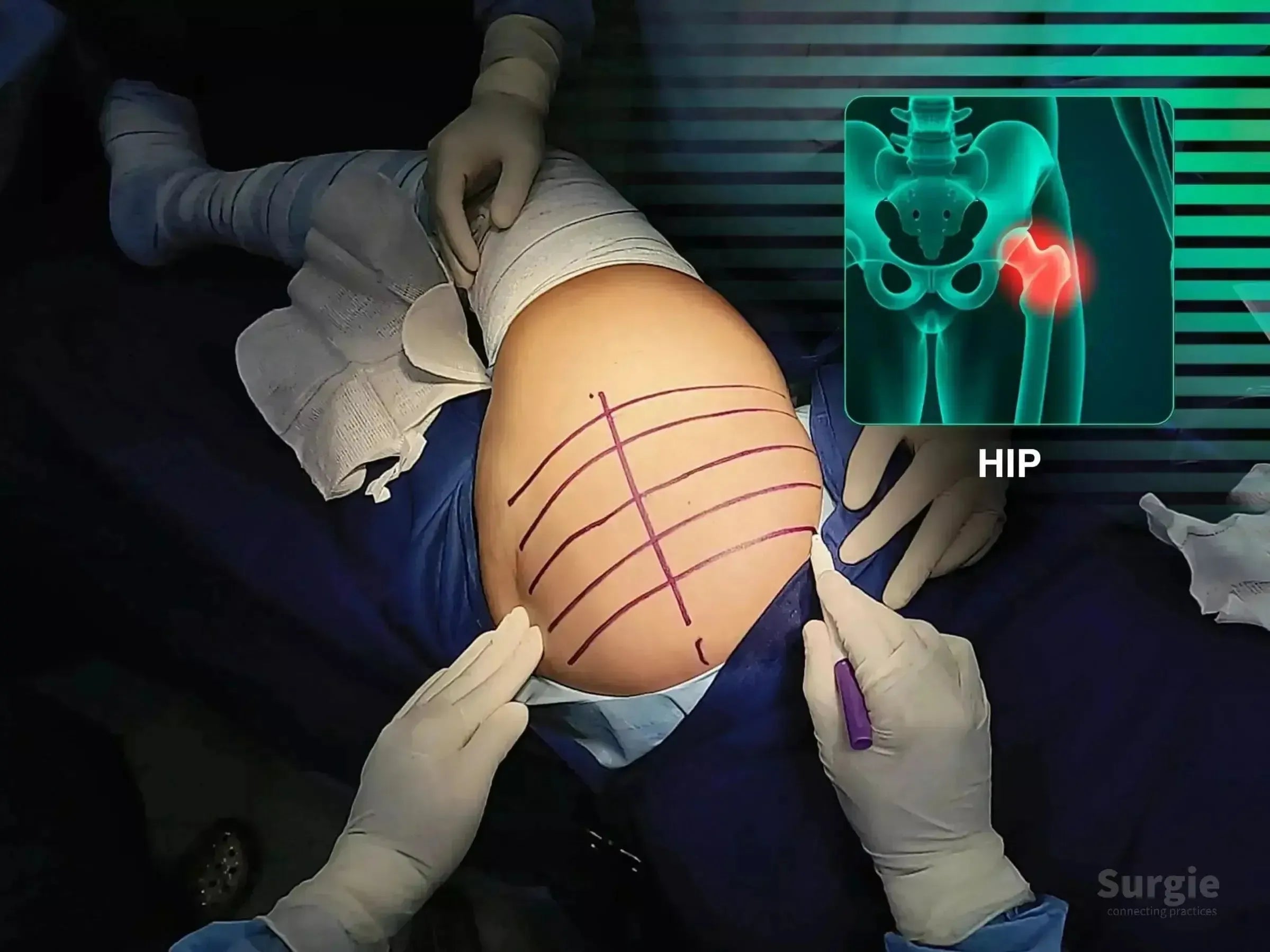 Surgeon marking a patient's hip for posterior approach surgery with a digital anatomical overlay highlighting the hip joint.