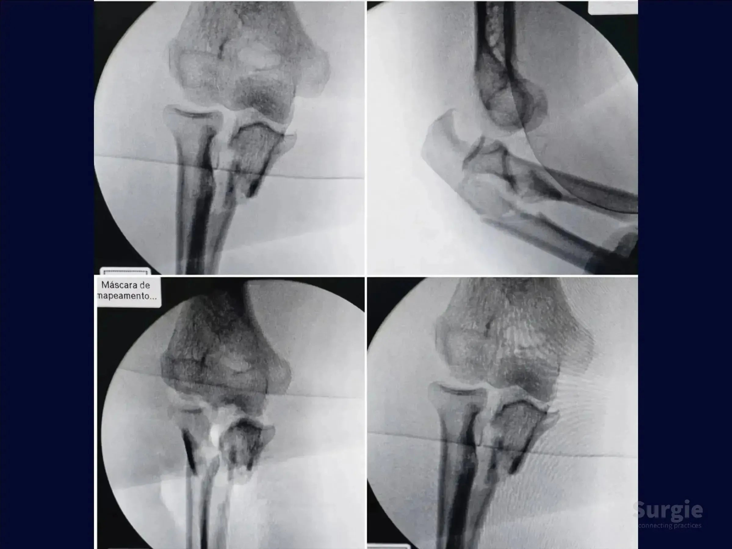 Fluoroscopic X-ray views showing a transolecranon fracture-dislocation of the elbow with proximal ulnar displacement.