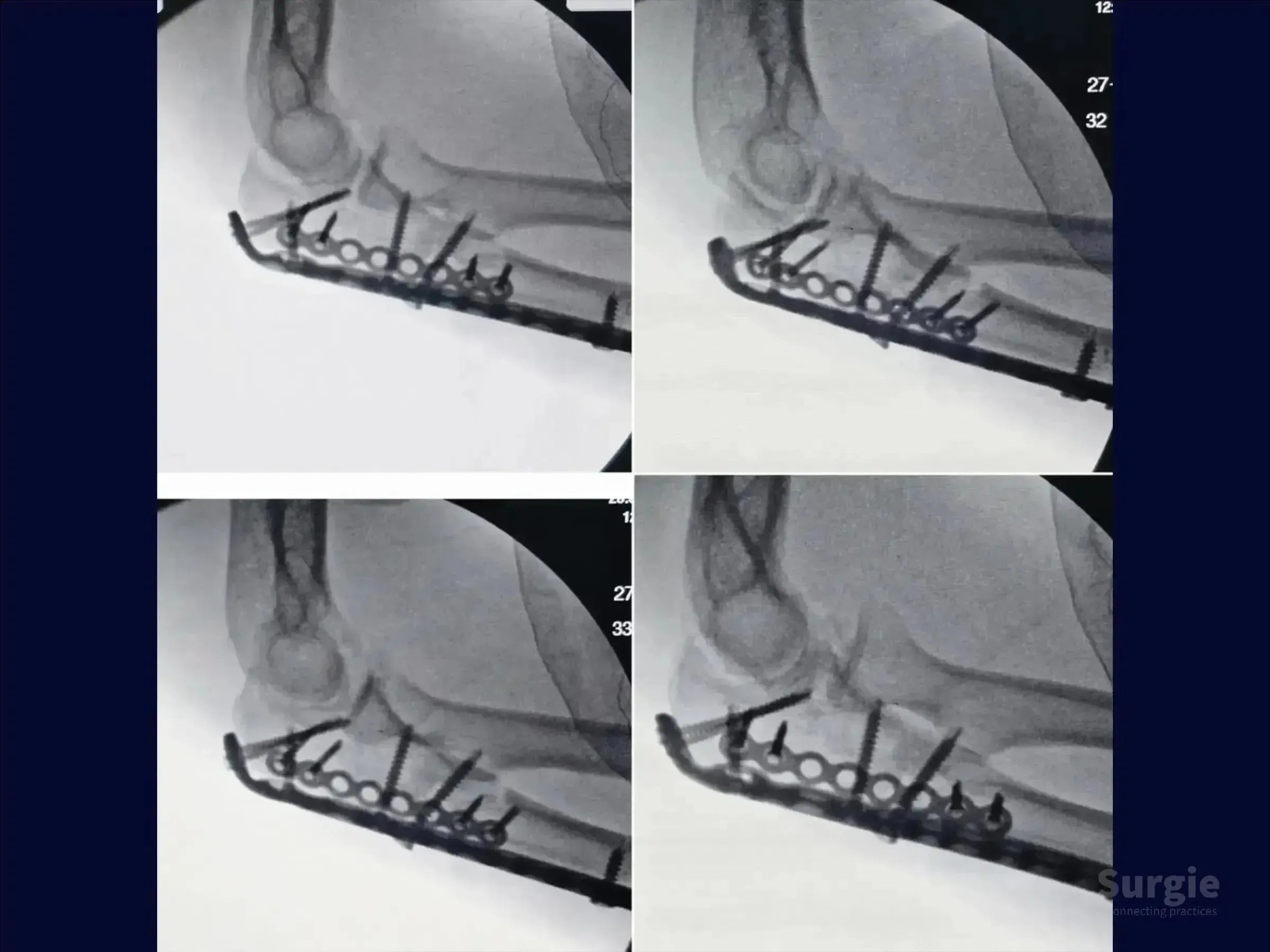 X-ray showing internal fixation of a transolecranon fracture with a metal plate and screws in the proximal ulna.