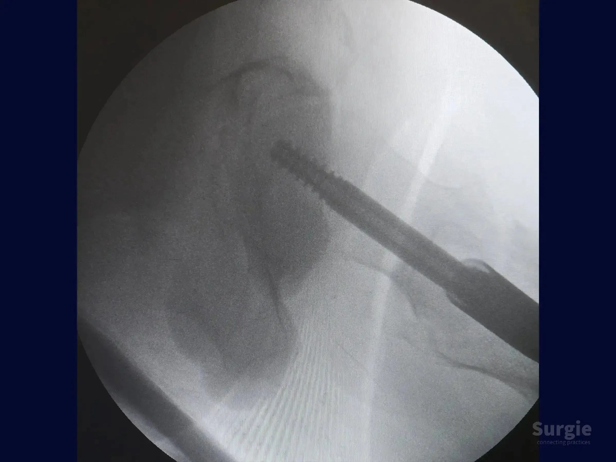 Fluoroscopic X-ray showing an intramedullary nail inserted into a transtrochanteric femur fracture.