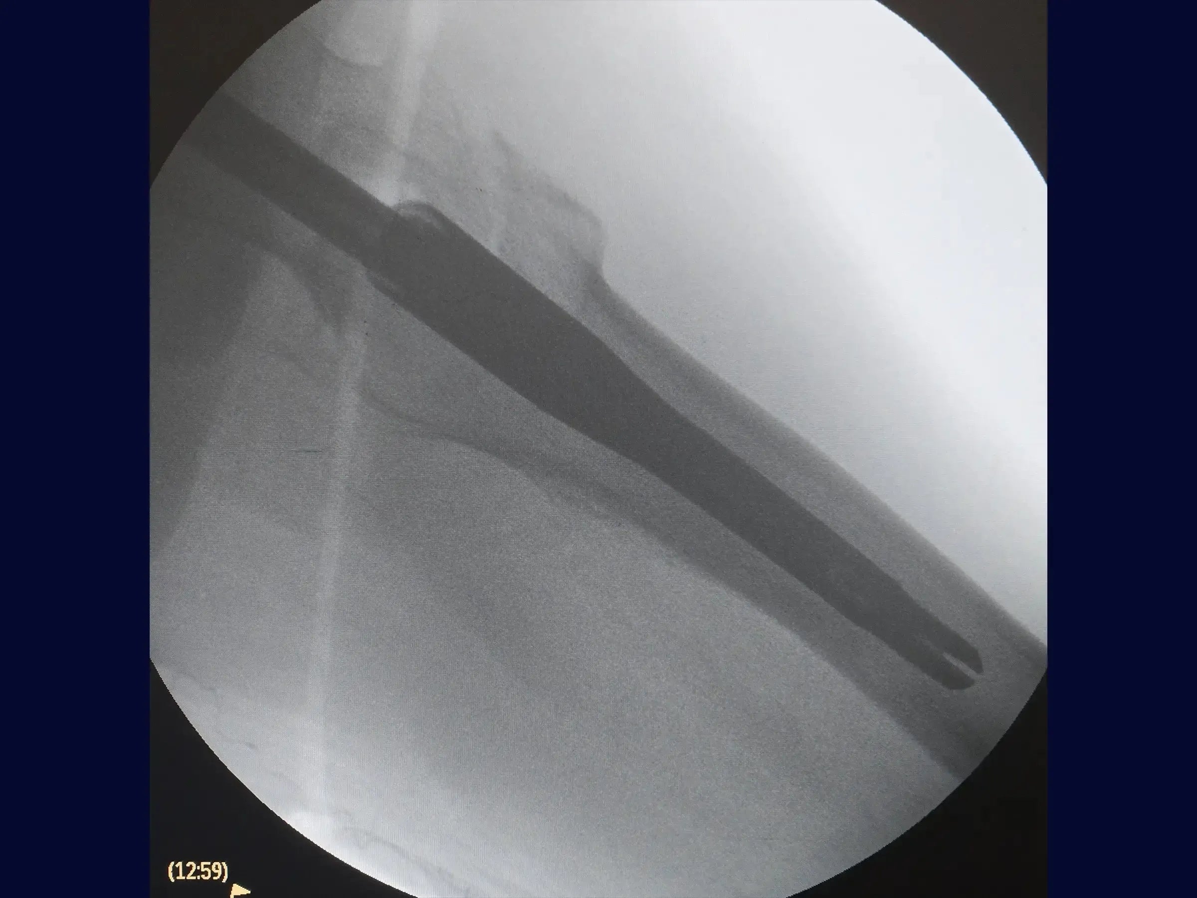 Transtrochanteric Fracture with Intramedullary Nail (Without Traction Table) 01