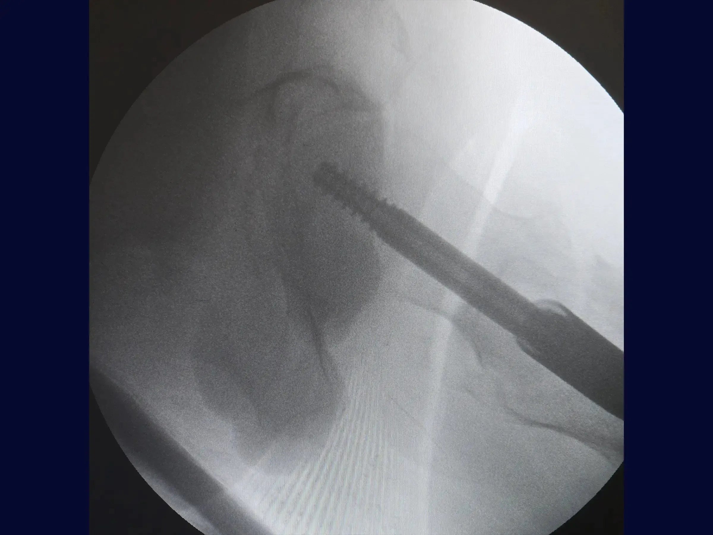 Transtrochanteric Fracture with Intramedullary Nail (Without Traction Table) 01