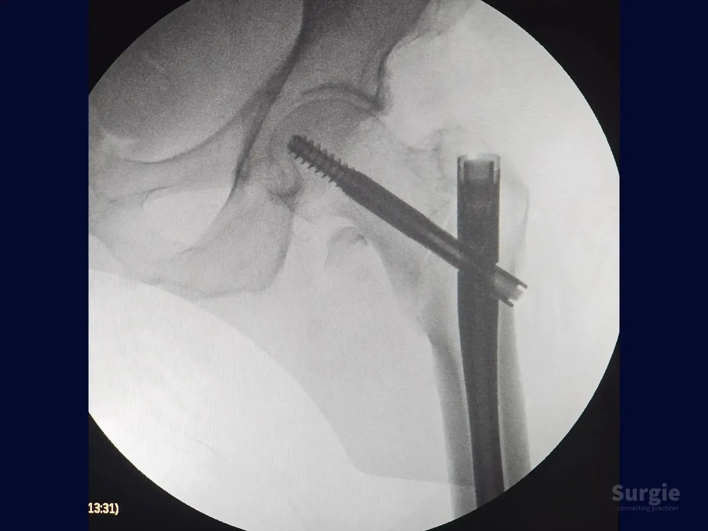 Fluoroscopic view of a proximal femur fracture stabilized with an intramedullary nail and a cephalomedullary screw.