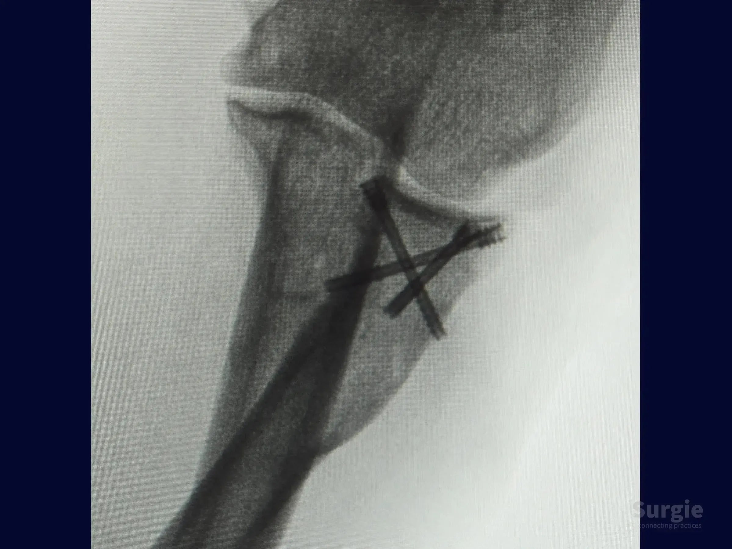 X-ray showing radial head fixation with crossed compression screws in a tripod configuration.