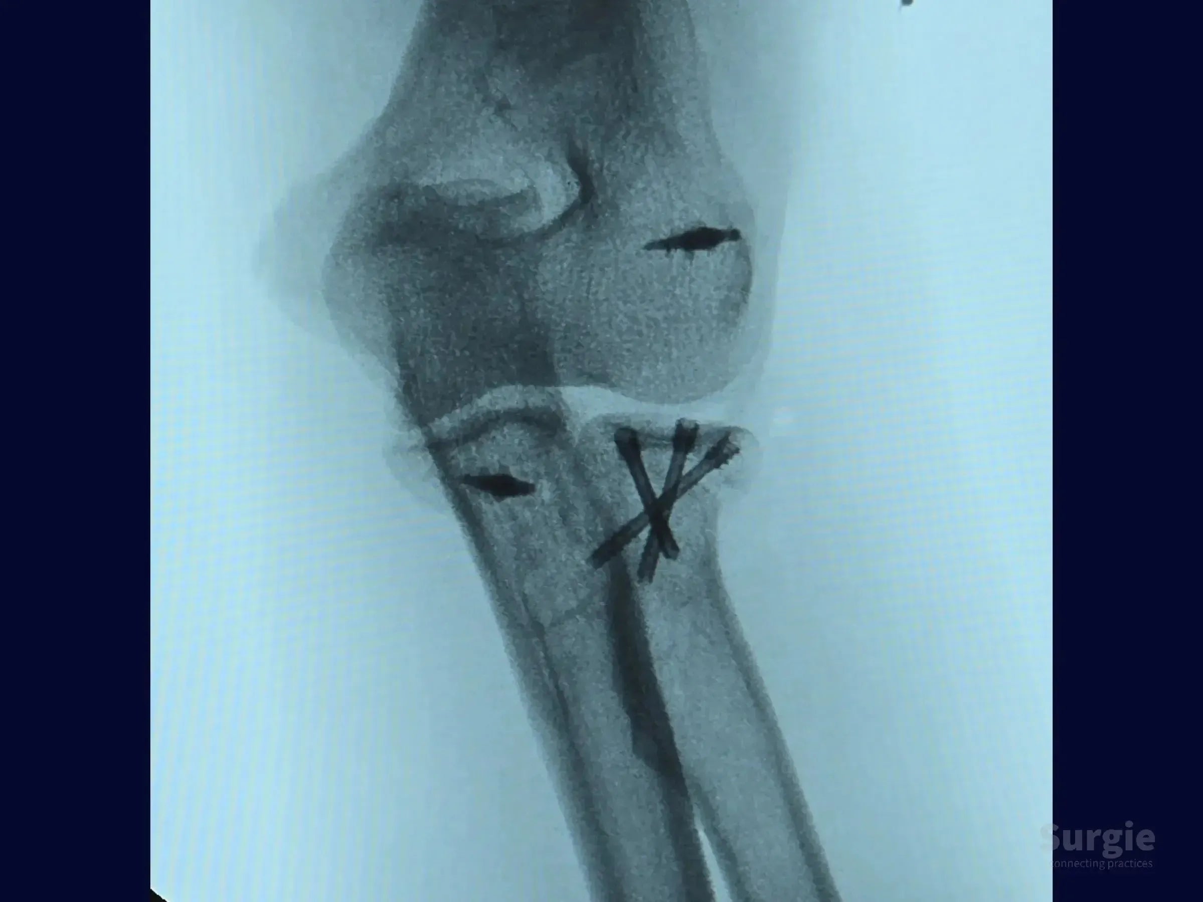 X-ray showing radial head fixation with crossed double-compression screws and a metallic anchor in the elbow joint.