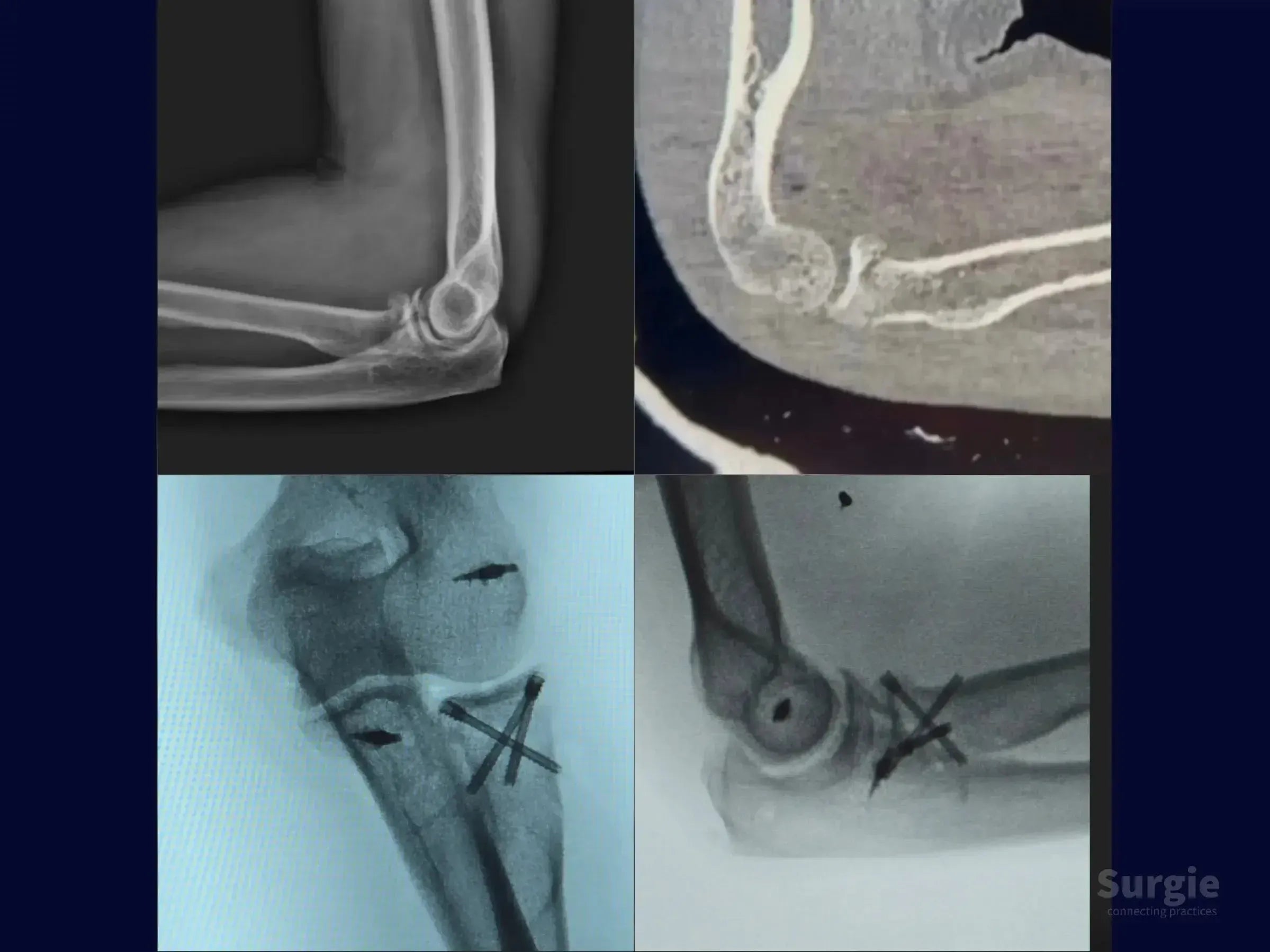 X-ray and CT scan showing radial head fracture fixation using the tripod technique with double-compression screws.