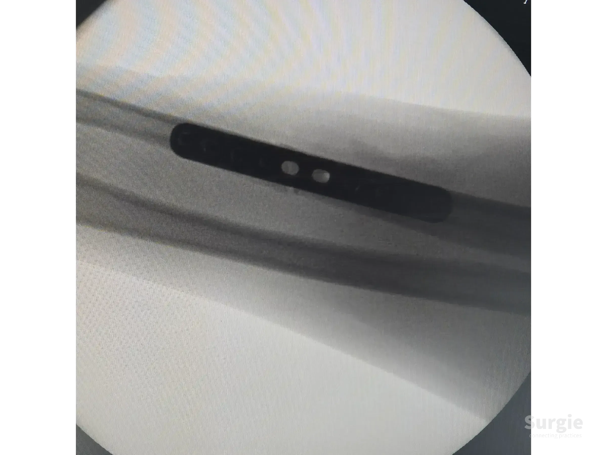 X-ray showing a metallic orthopedic plate fixed to an ulnar shaft fracture with surgical screws for bone stabilization.