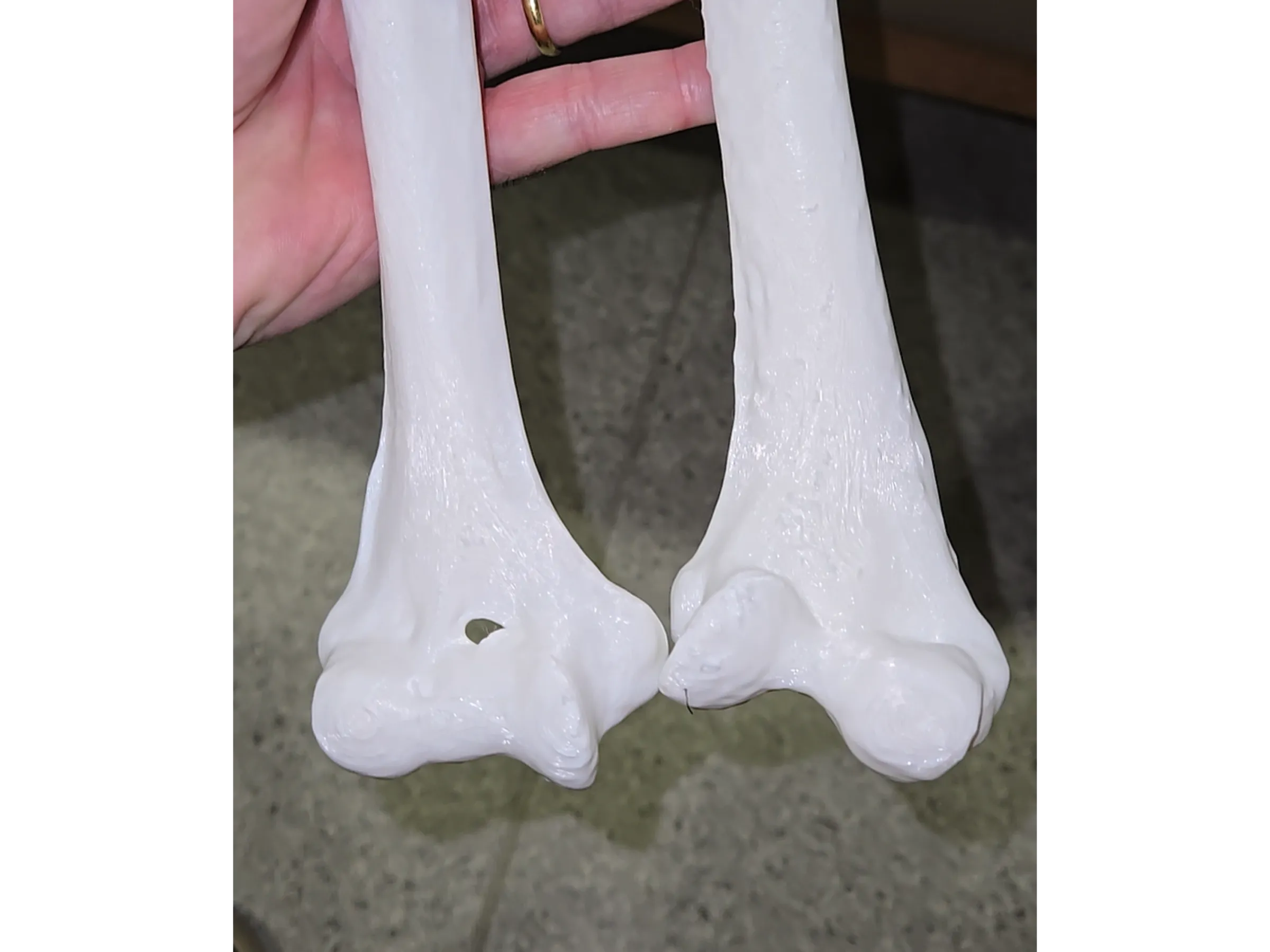 Distal Humerus Osteotomy – Cubitus Varus Deformity