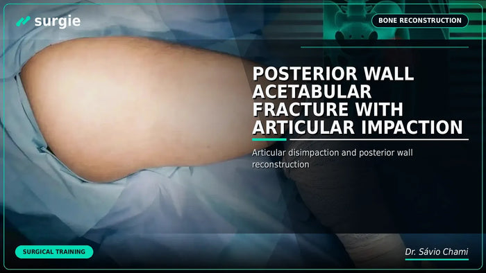 Posterior Wall Acetabular Fracture with Articular Impaction