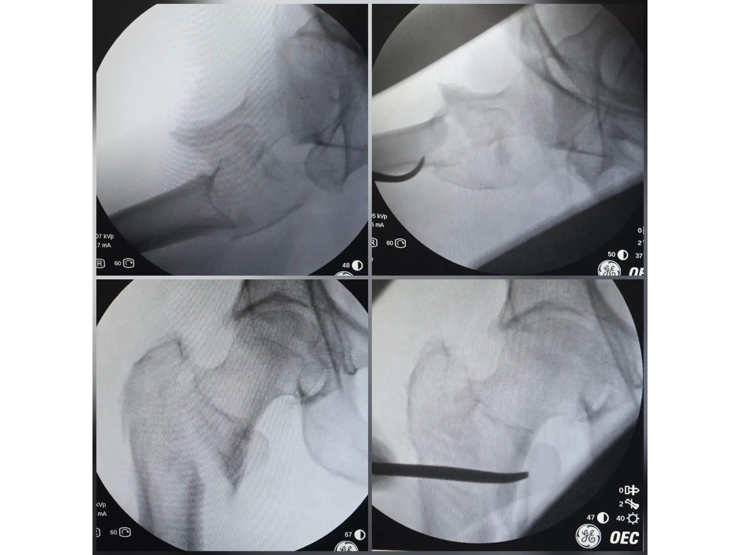 PROXIMALER FEMUR [Fall 4] · Doppel-Wippen-Technik