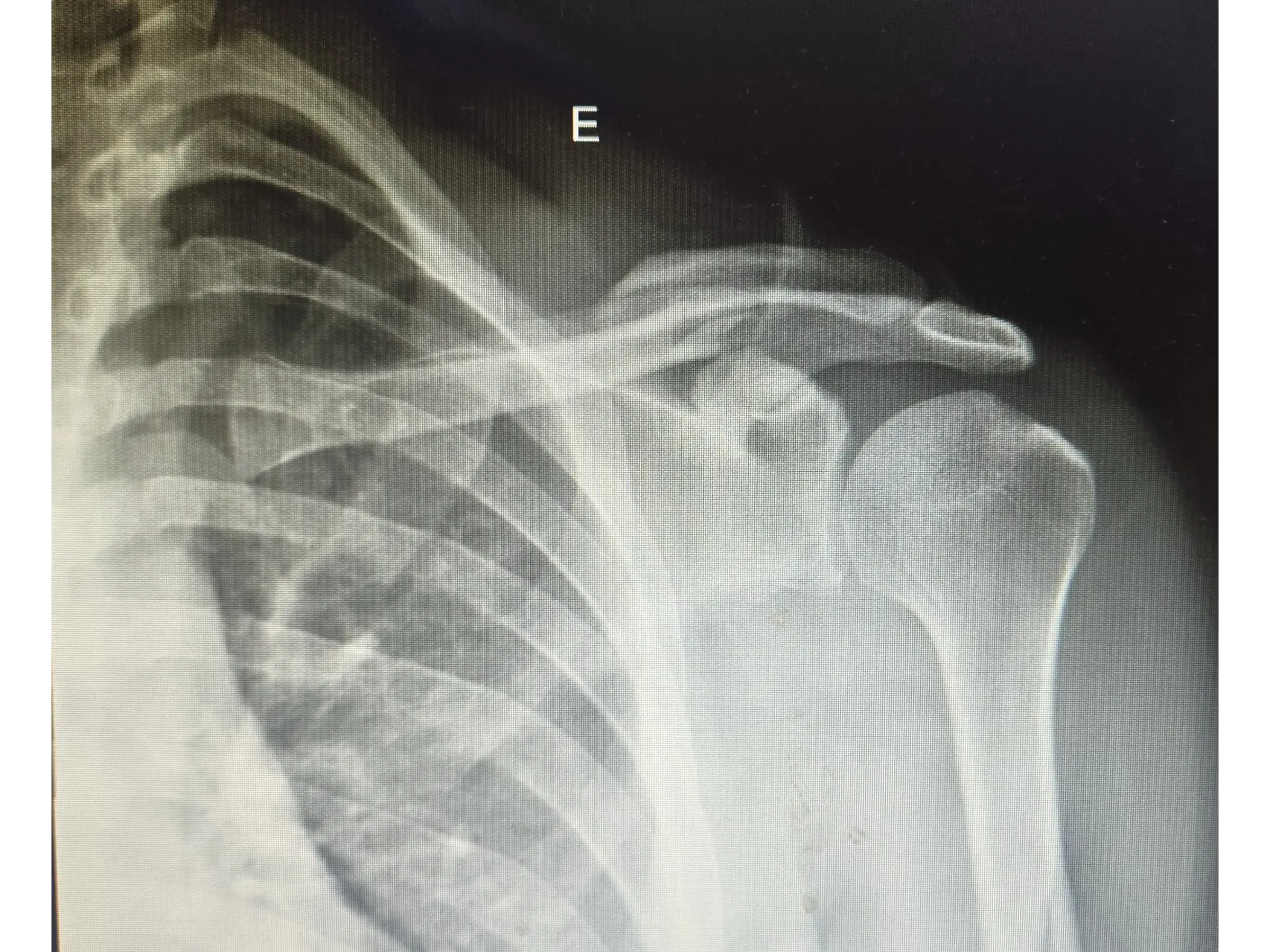 Clavicle Fracture 02 – Minimally Invasive Technique