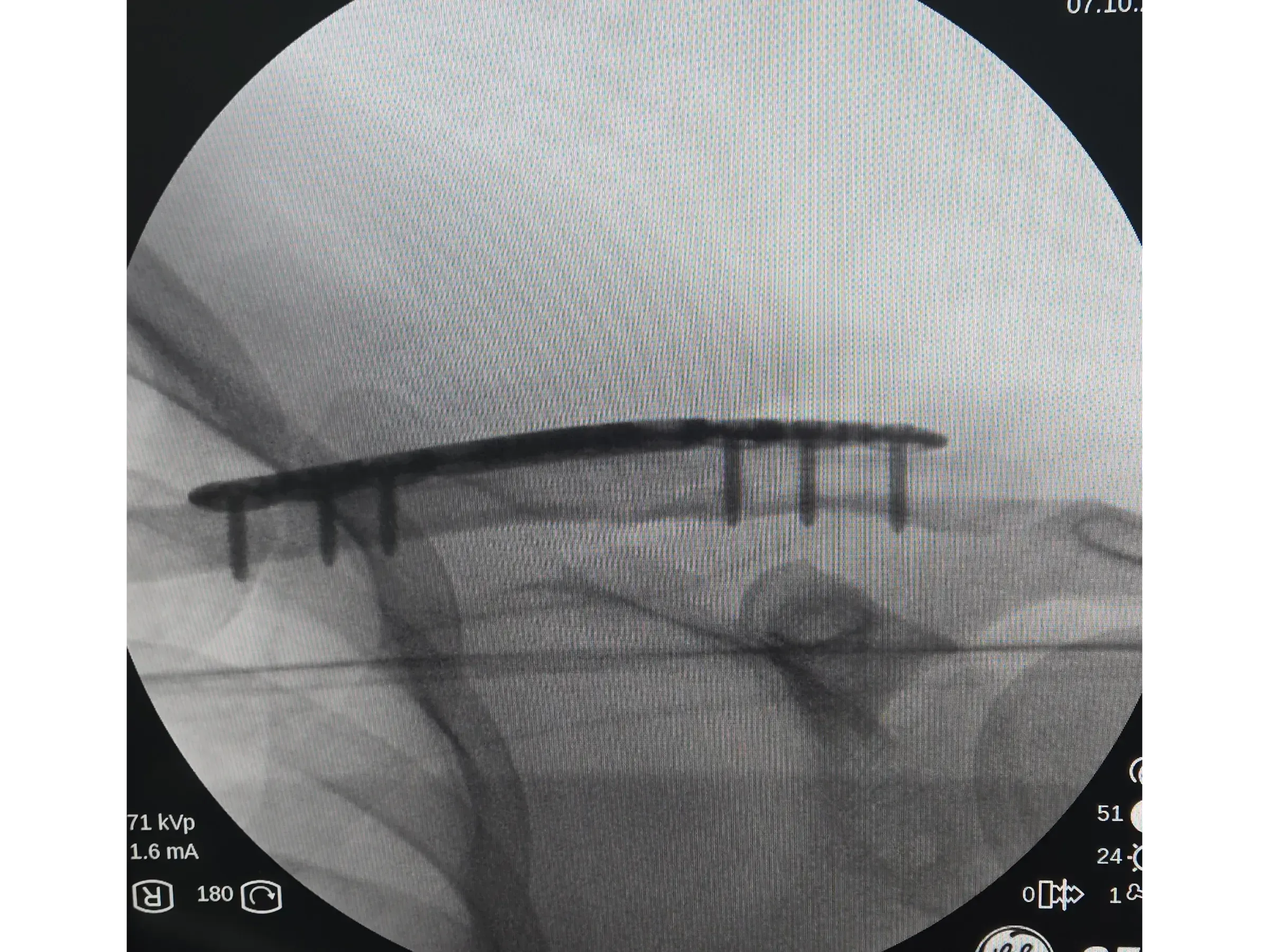 Clavicle Fracture 02 – Minimally Invasive Technique