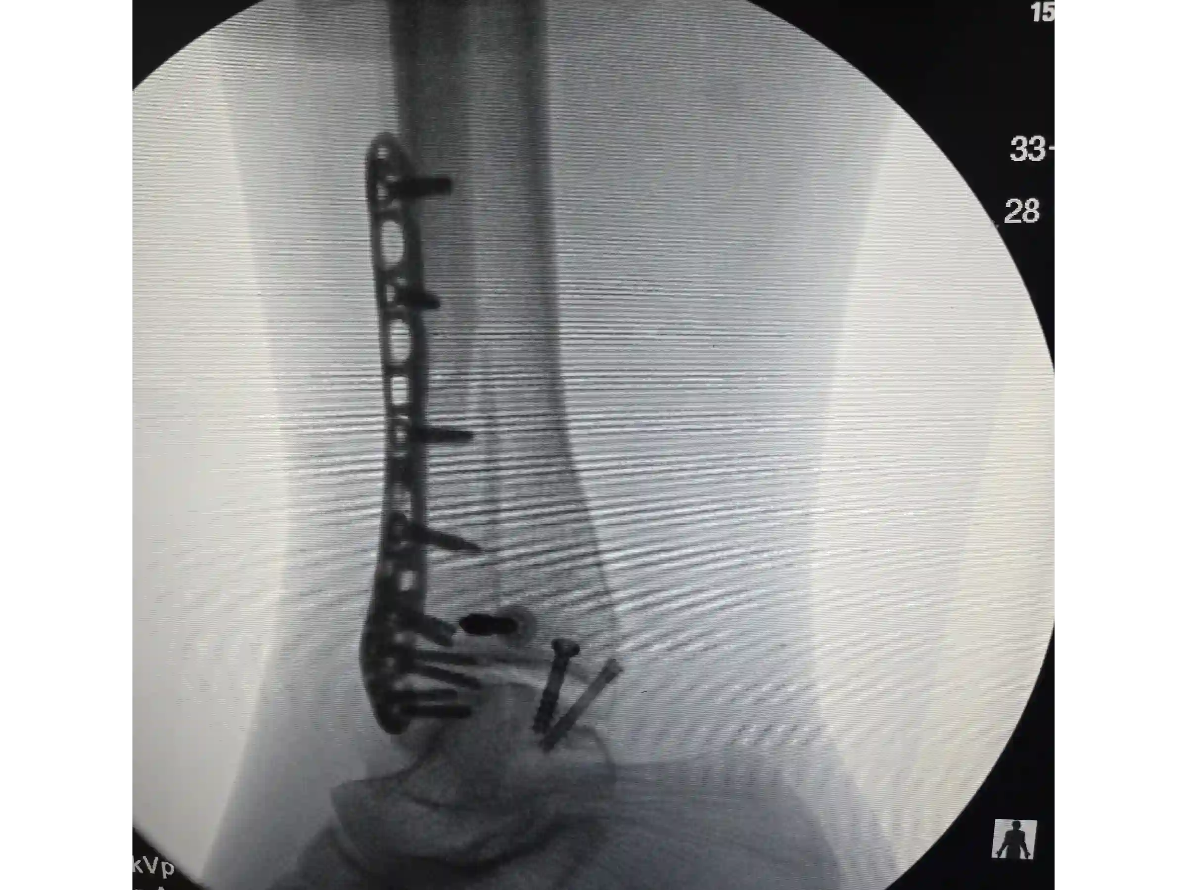 TRIMALLEOLAR [CASE 03] POSTEROLATERAL APPROACH + ANTEGRADE MEDIAL MALLEOLUS FIXATION