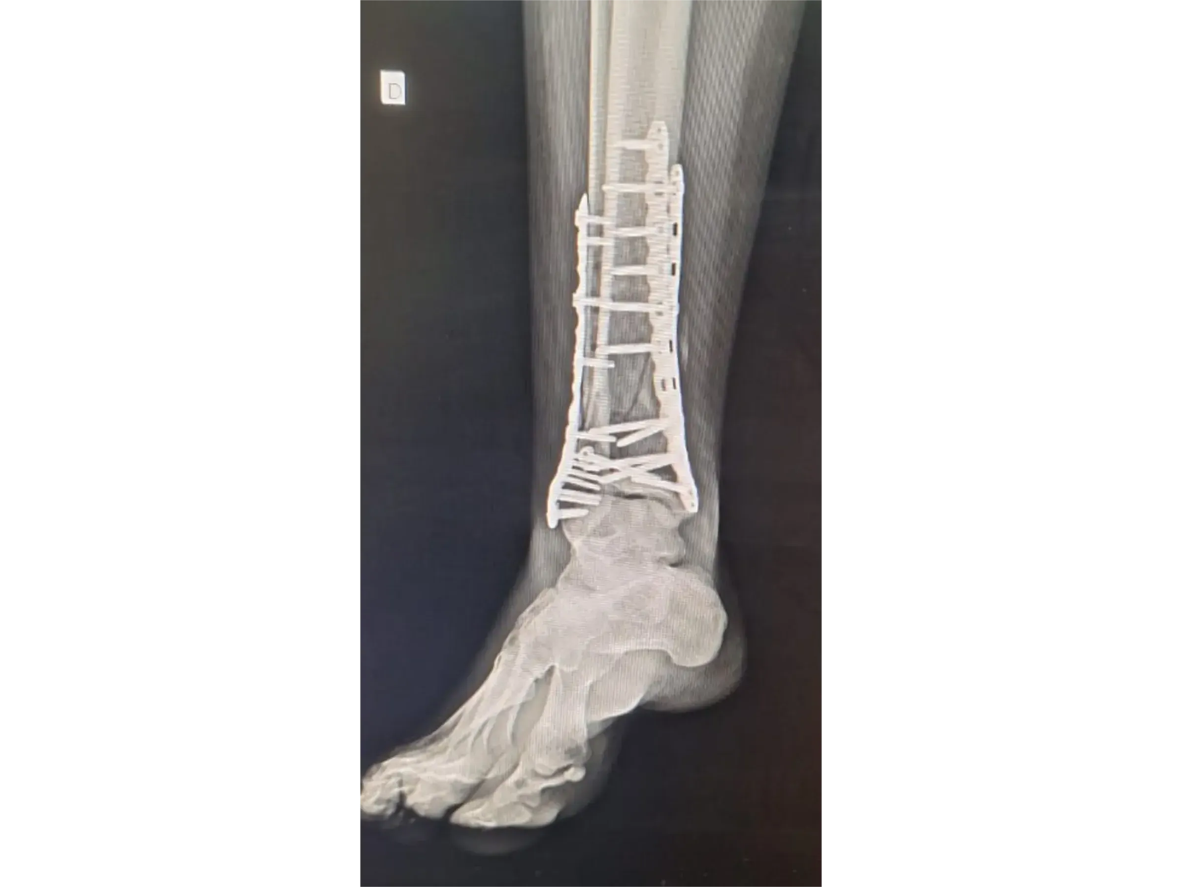 TIBIAL PILON [Case 2] · Posteromedial + Lateral Approach