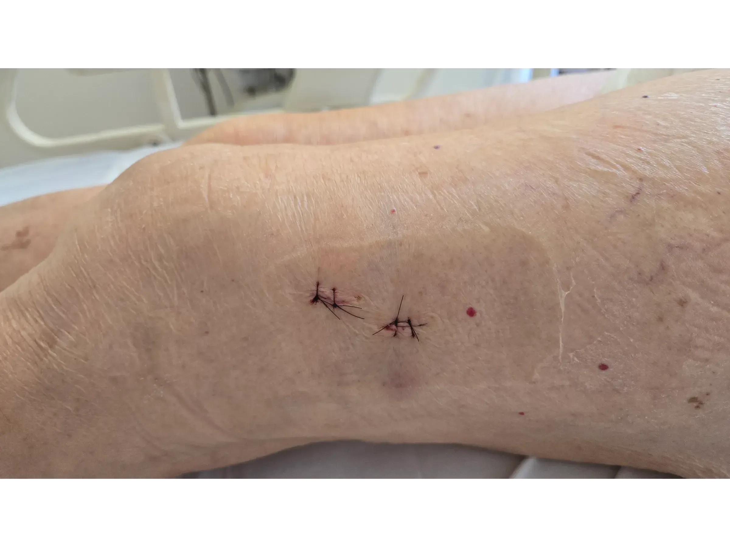 SUBTROCHANTÄRE FRAKTUR [Fall 1] · Minimalinvasive intramedulläre Nagelung