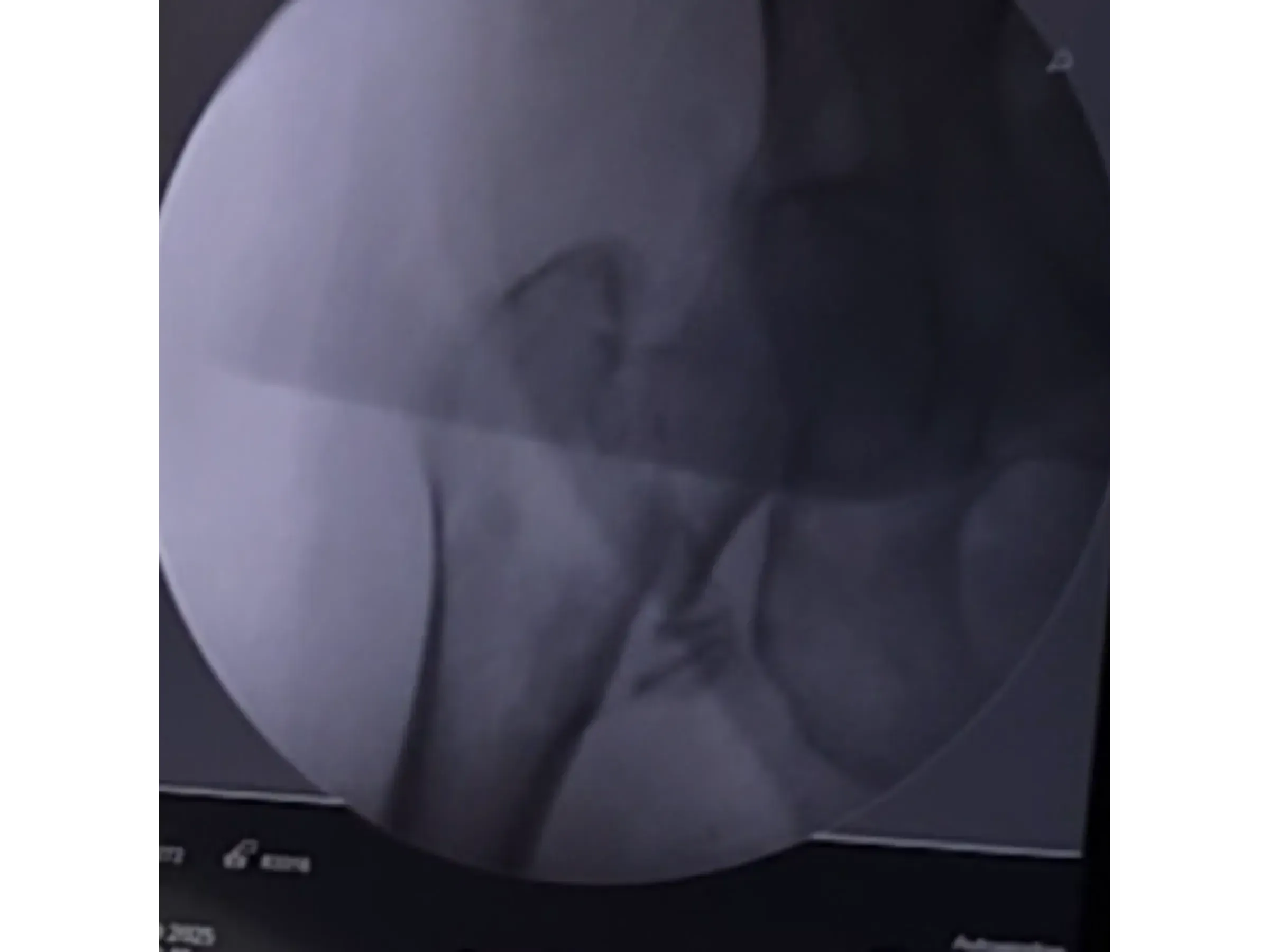 Intramedullärer Nagel für den proximalen Femur 03 – Rocker (Wippen)-Manöver