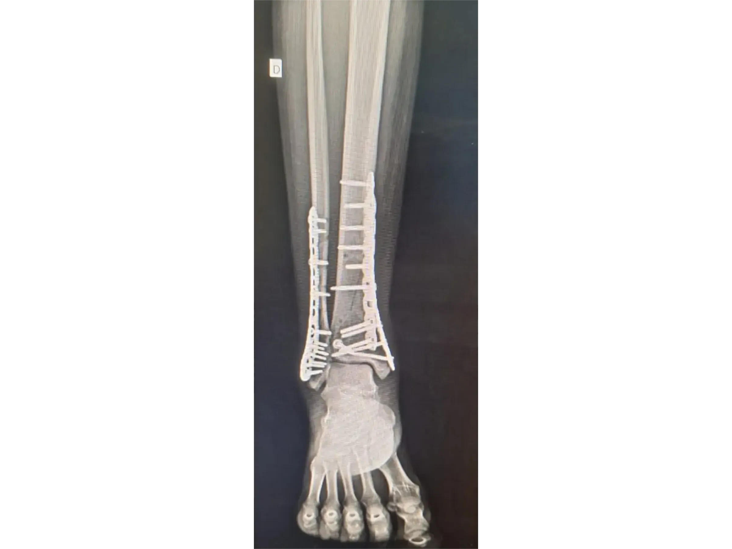 TIBIAL PILON [Case 2] · Posteromedial + Lateral Approach