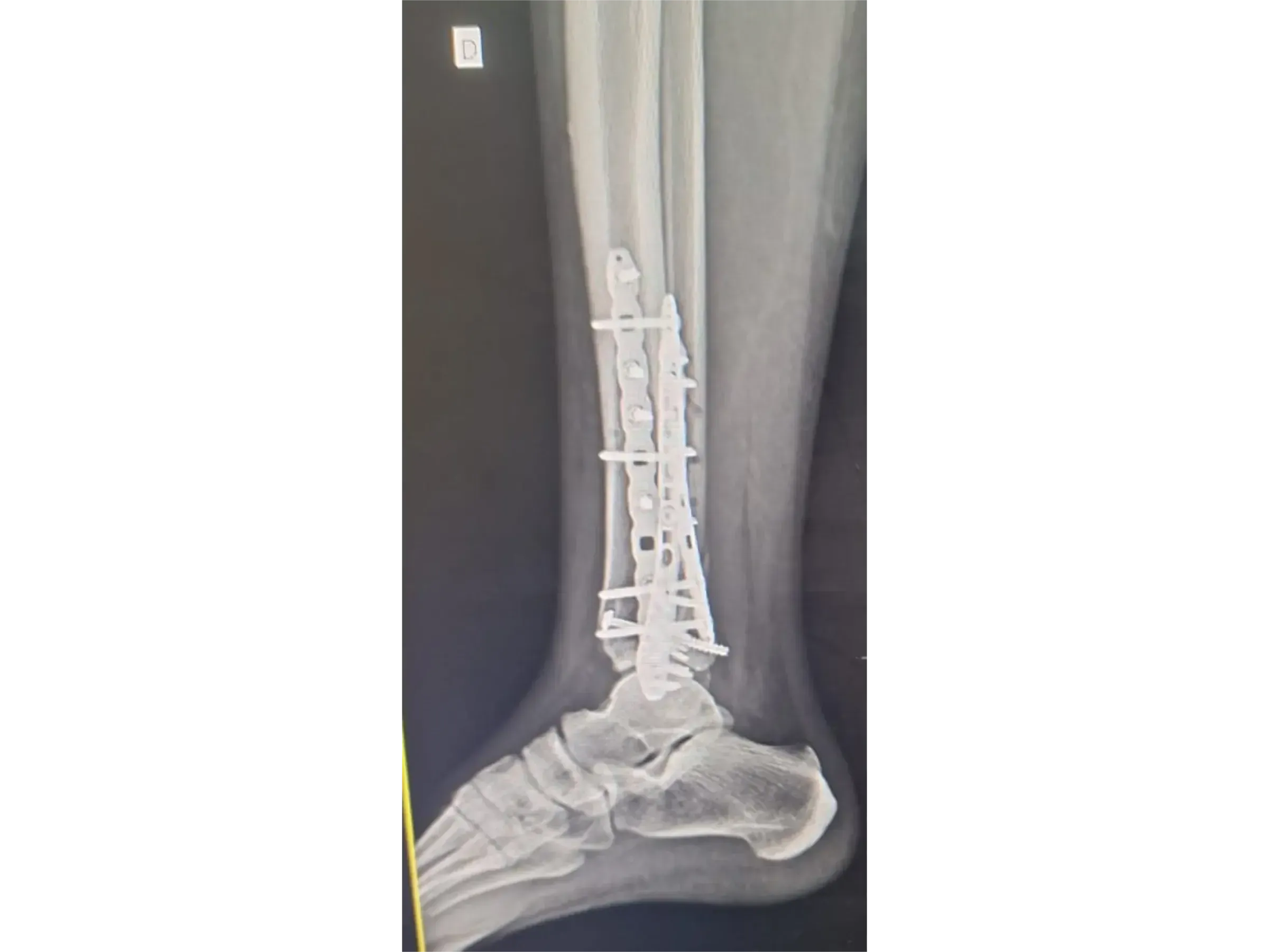 TIBIAL PILON [Case 2] · Posteromedial + Lateral Approach