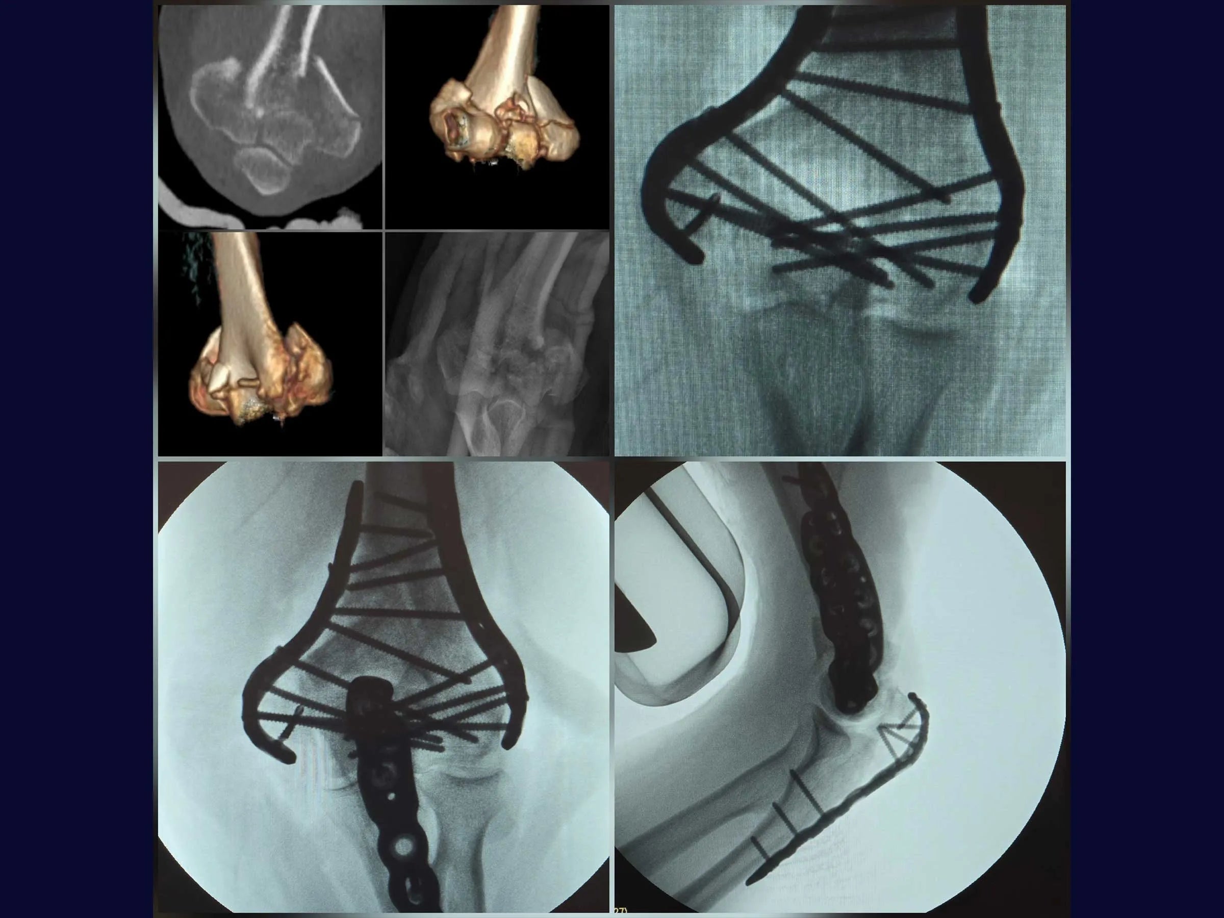 Comminuted Articular Fracture of the Distal Humerus