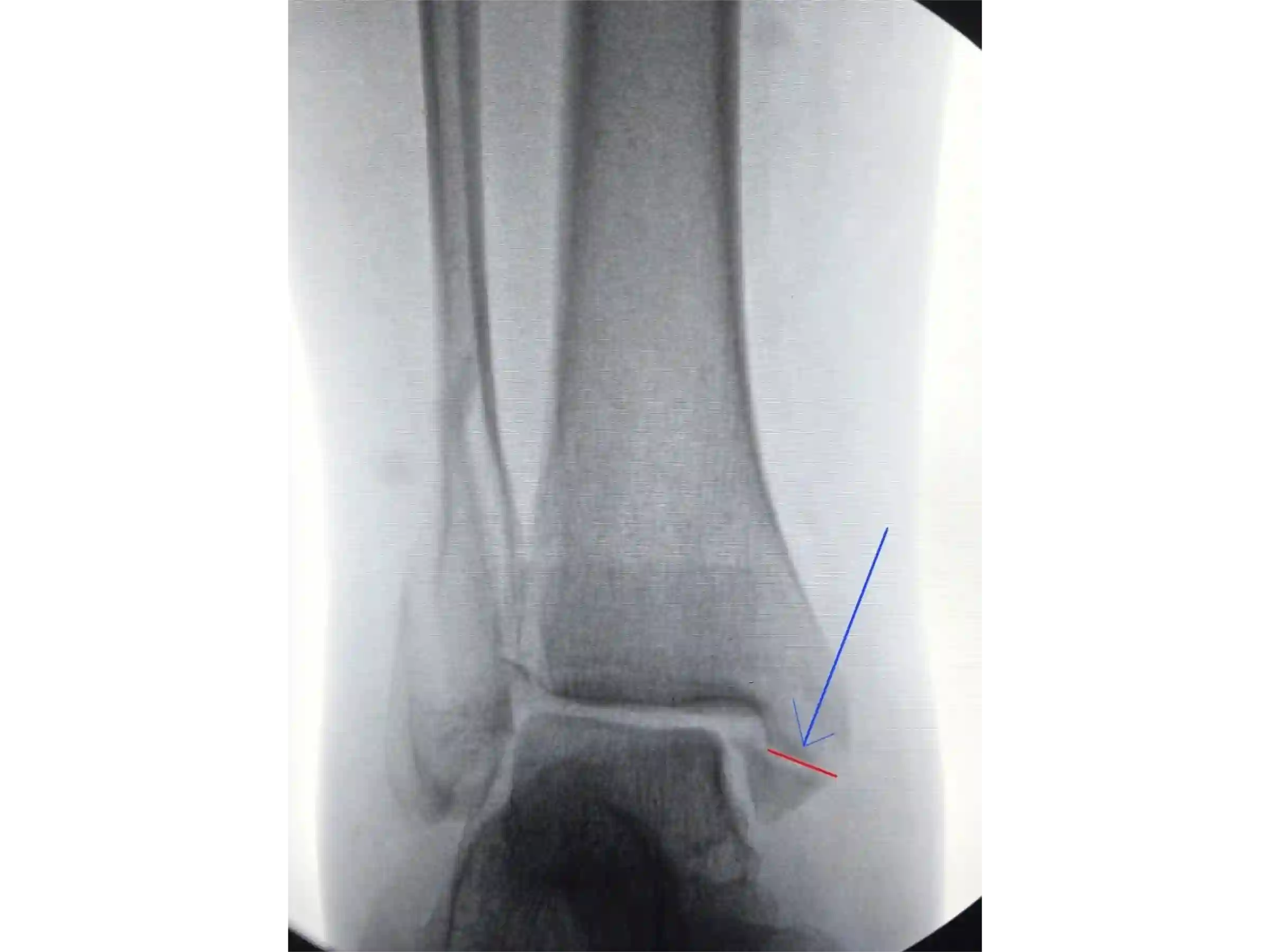 TRIMALLEOLAR [CASE 03] POSTEROLATERAL APPROACH + ANTEGRADE MEDIAL MALLEOLUS FIXATION