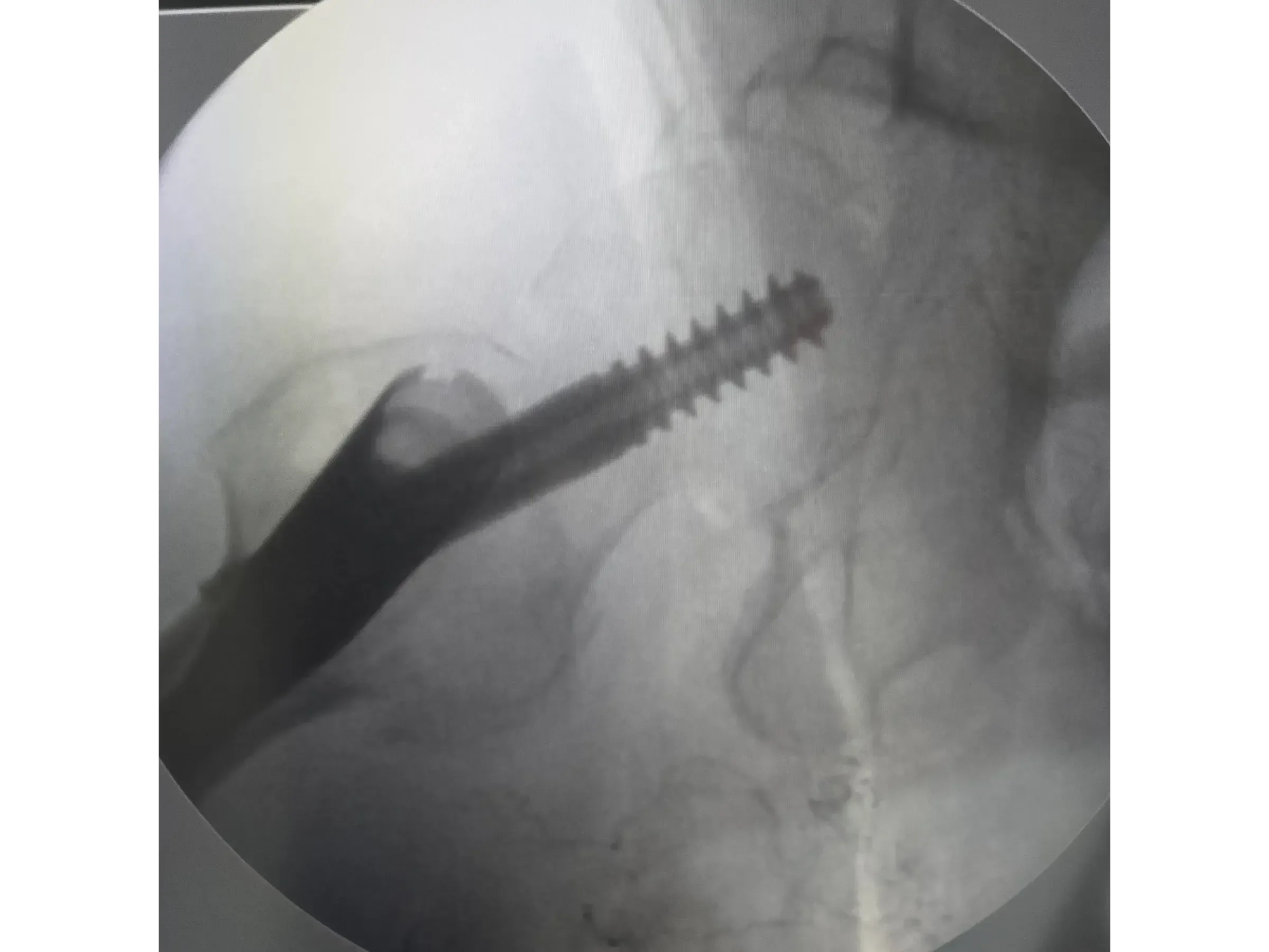 Intramedullärer Nagel für den proximalen Femur 03 – Rocker (Wippen)-Manöver