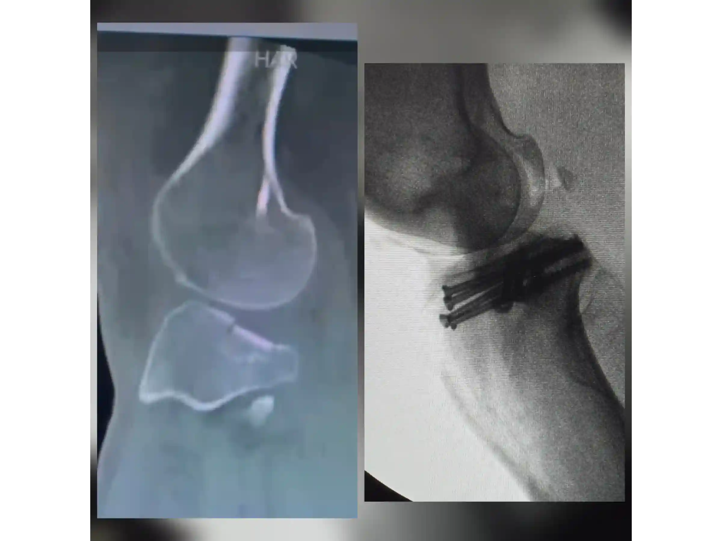 TIBIAL PLATEAU [CASE 03] Posterolateral Depression