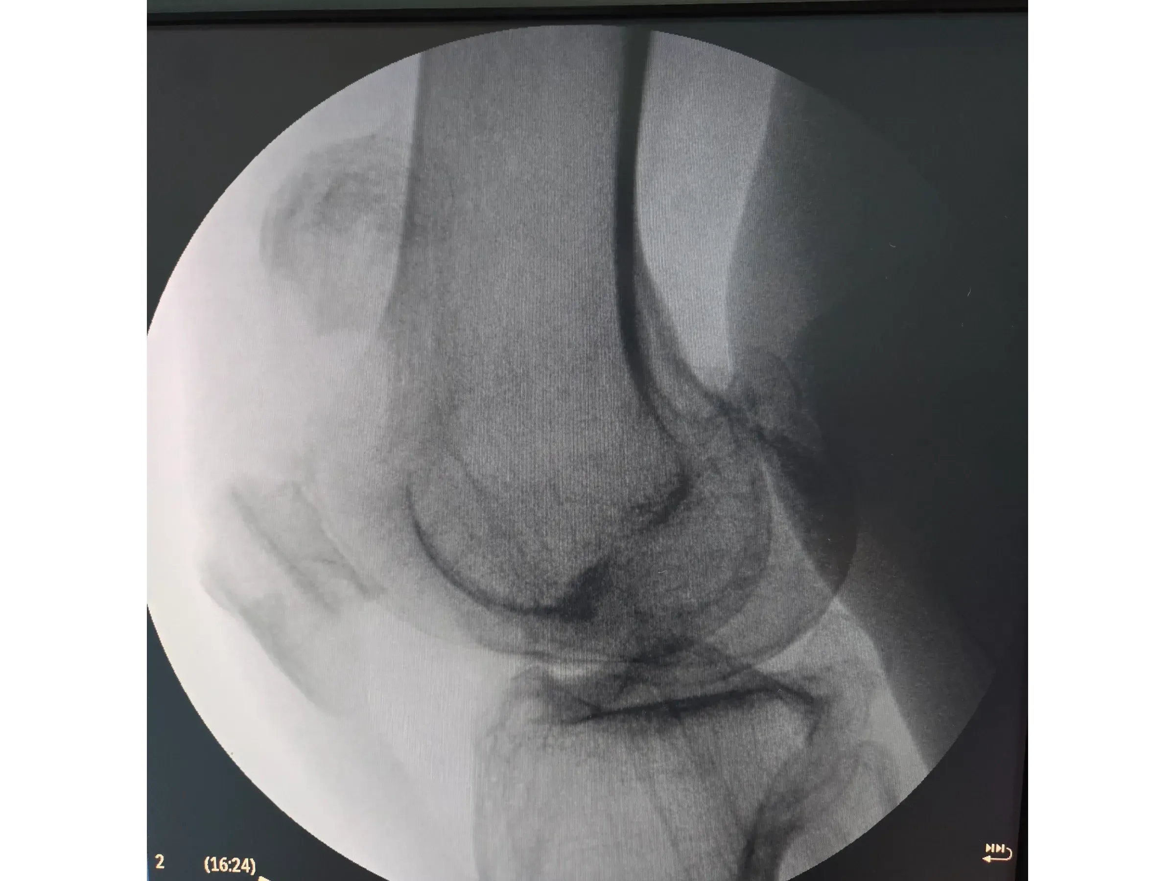 PATELLA [Case 2] · Cannulated Screws + Cerclage