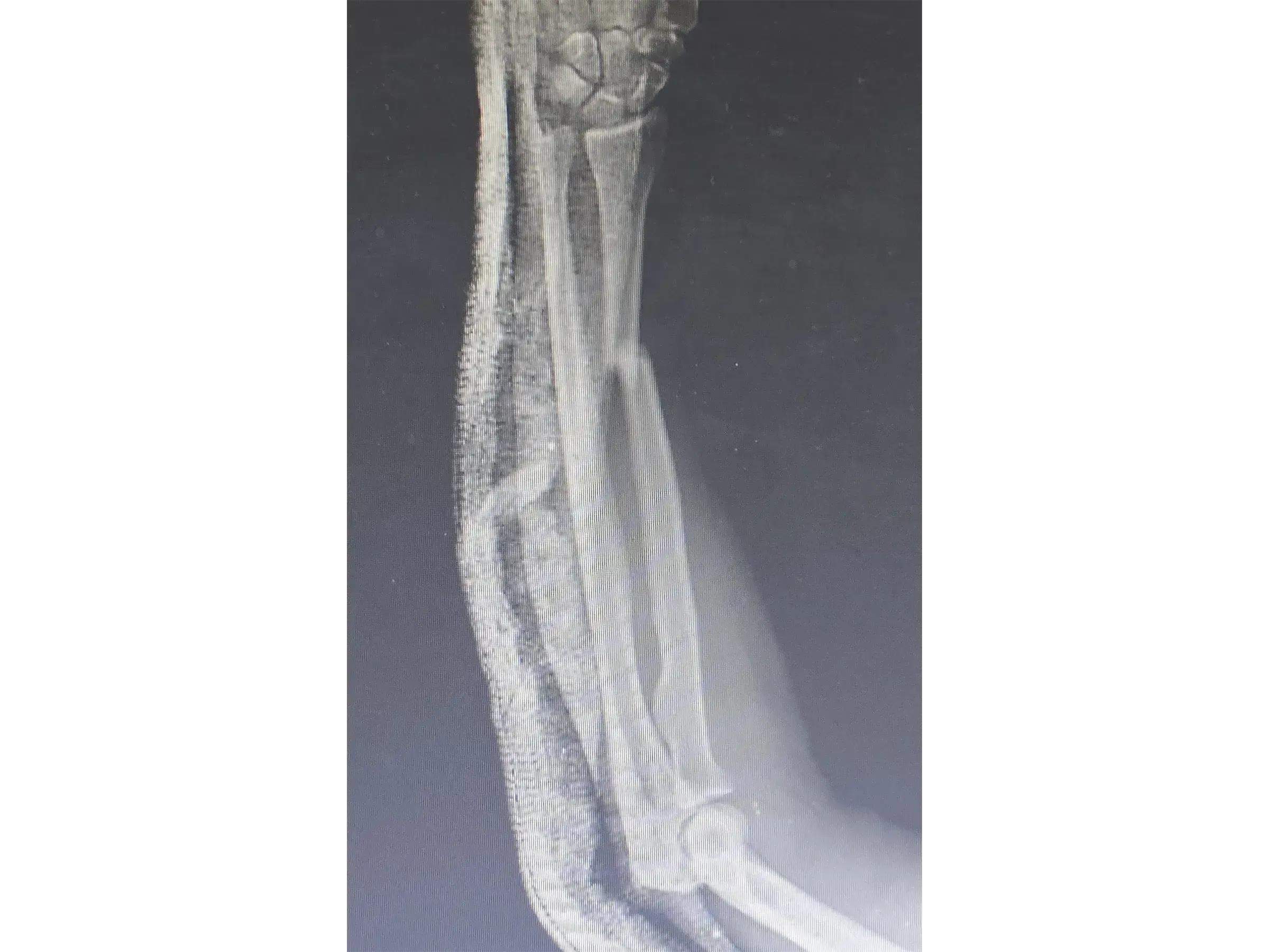 RADIAL SHAFT [Case 2] · Thompson Approach