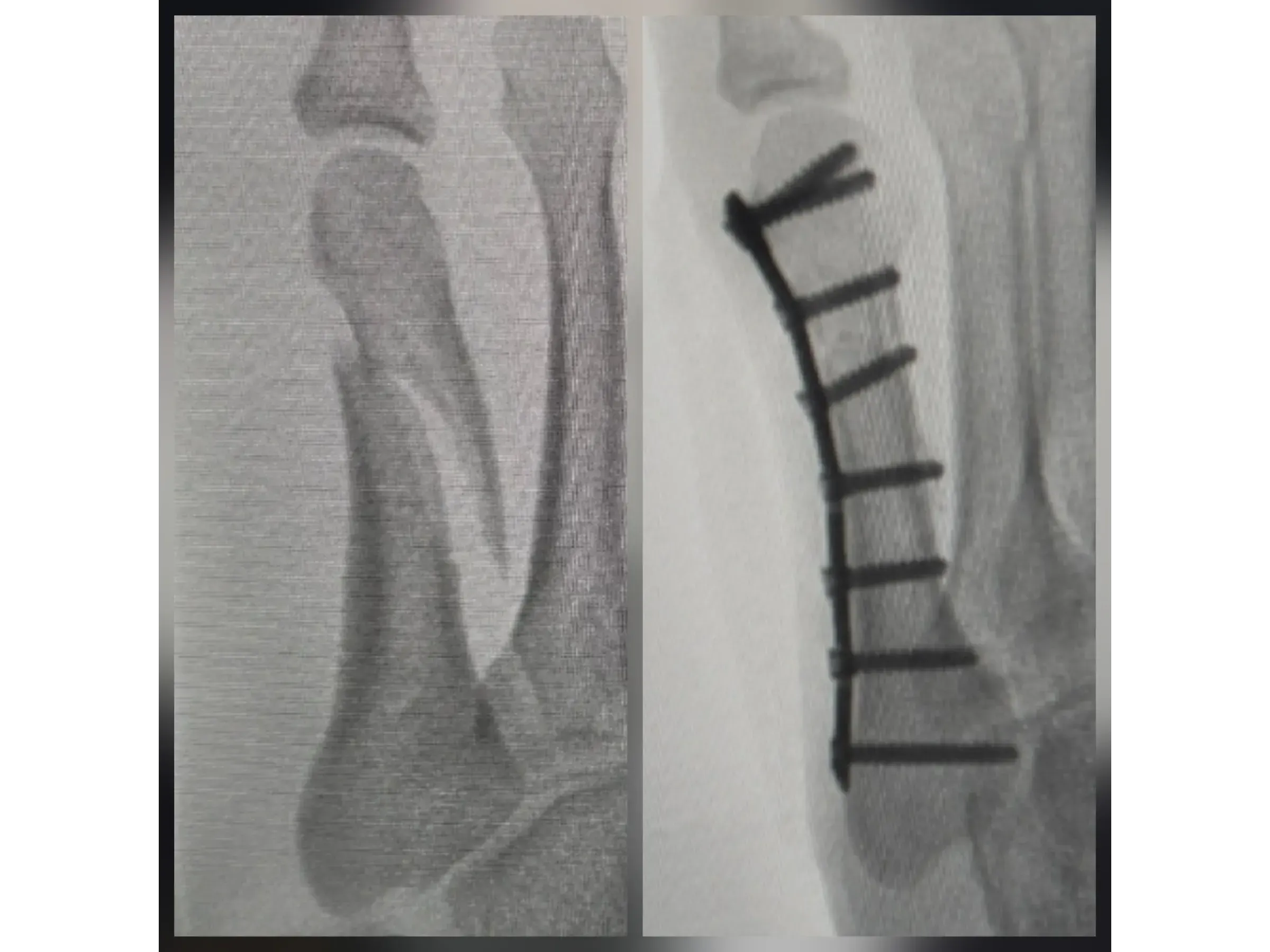 FIFTH METATARSAL [Case 2] · Mini-fragment Plate and Screws