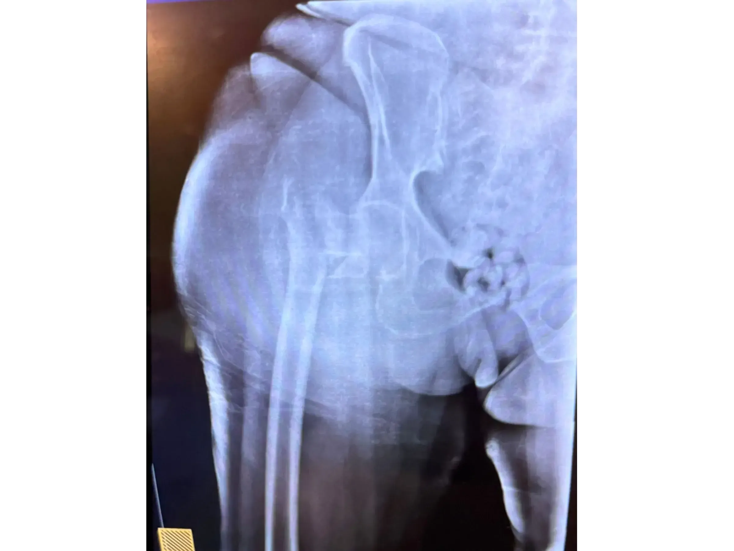 PROXIMALER FEMUR [Fall 4] · Doppel-Wippen-Technik