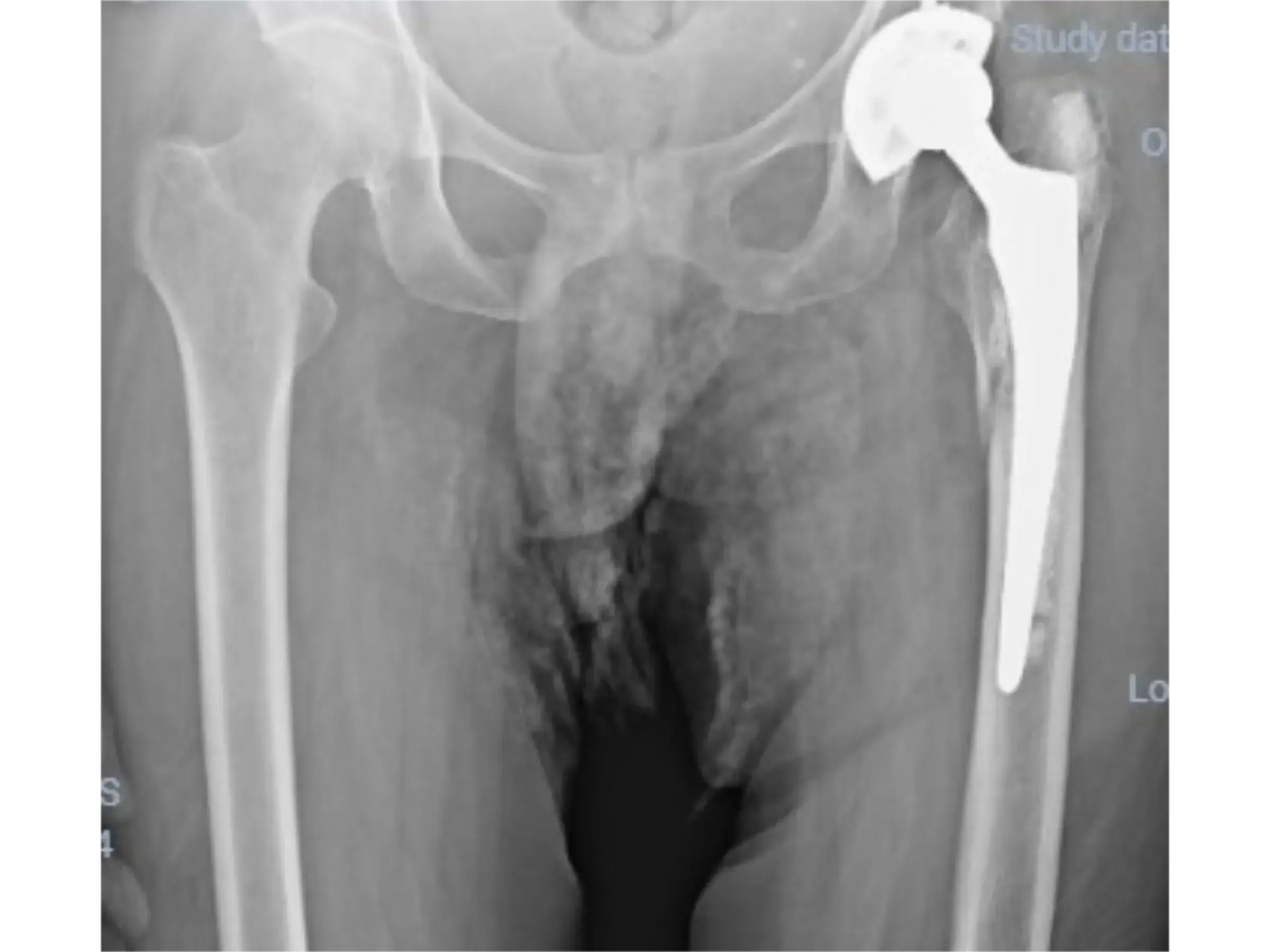 PERIPROSTHETIC HIP FRACTURE [Case 1] · Trochanteric Plate + Cerclage