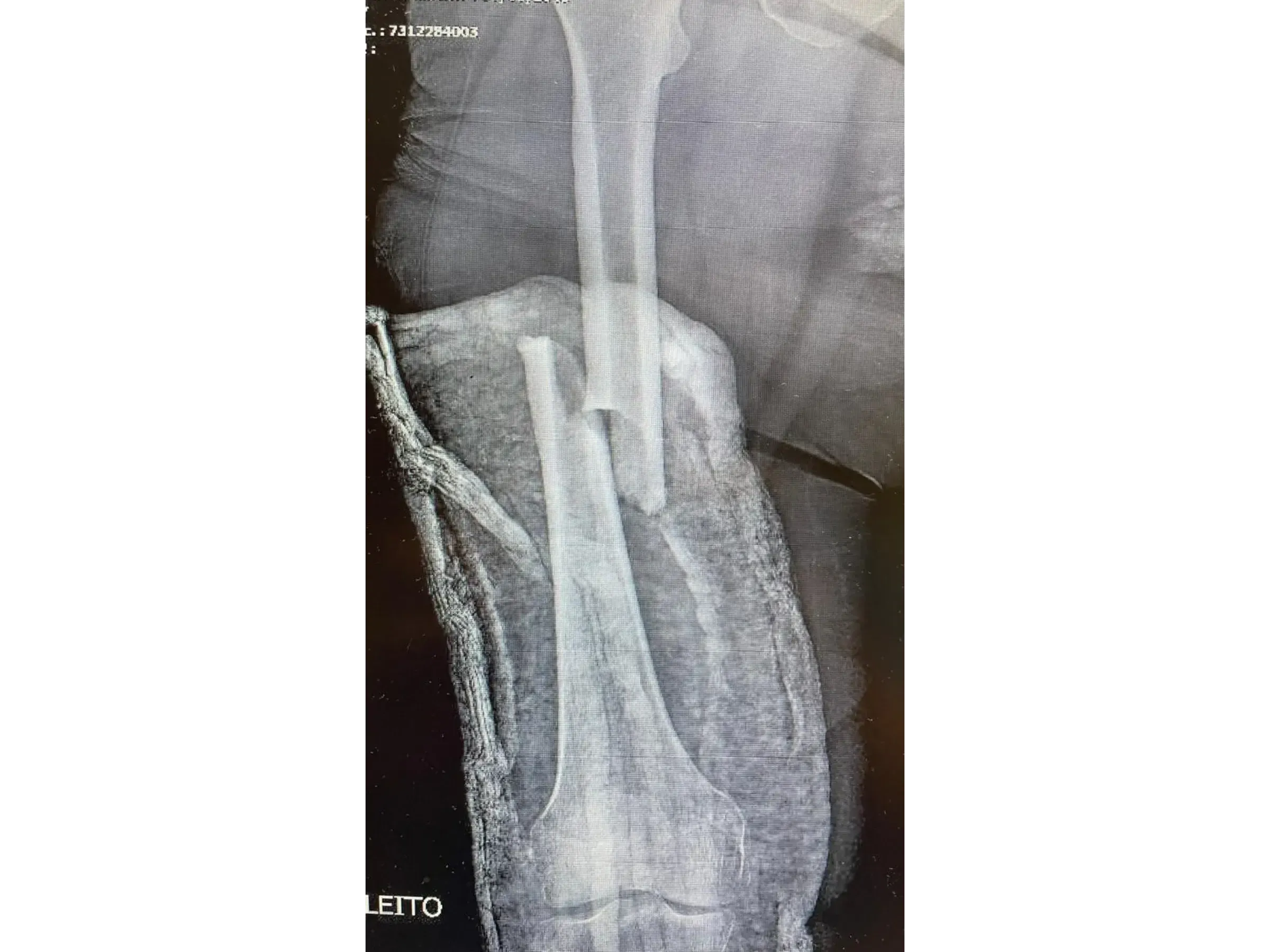 FEMORAL SHAFT [Case 2] · Retrograde Intramedullary Nail