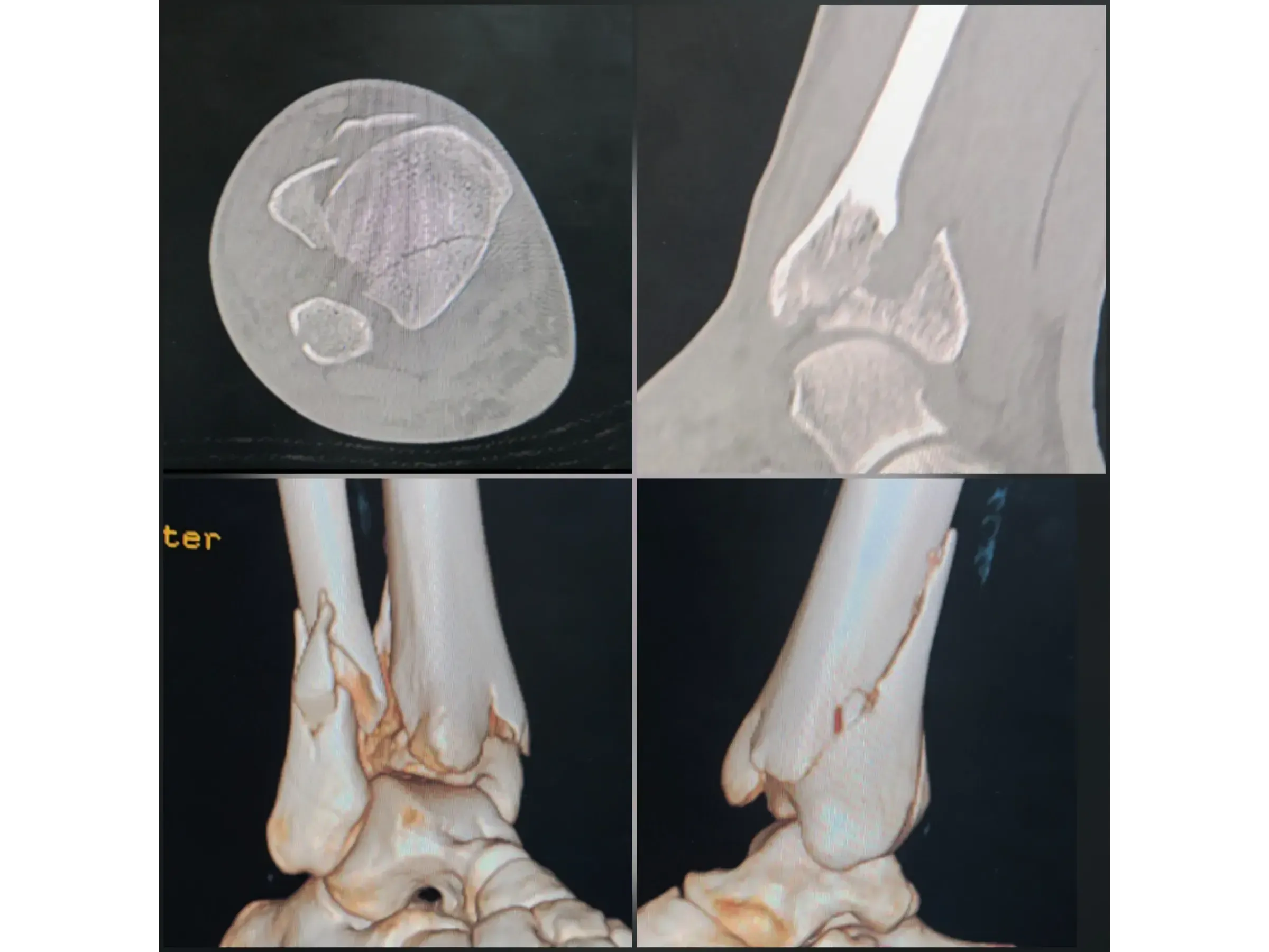 TIBIAL PILON [Case 2] · Posteromedial + Lateral Approach