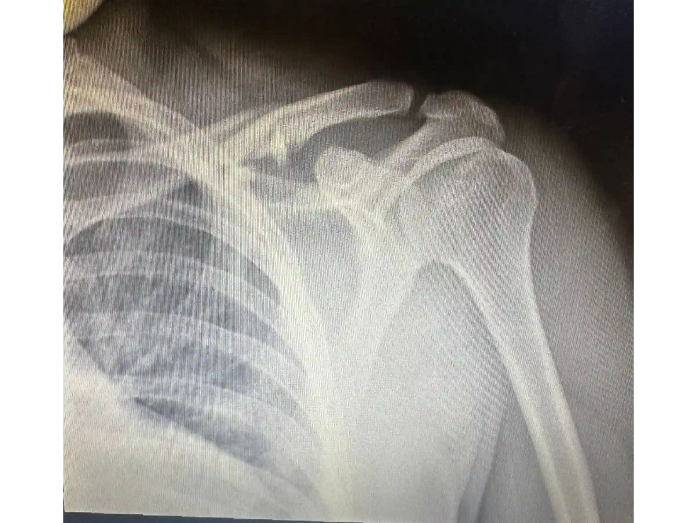 CLAVICLE [CASE 03] Minimally Invasive Percutaneous Osteosynthesis
