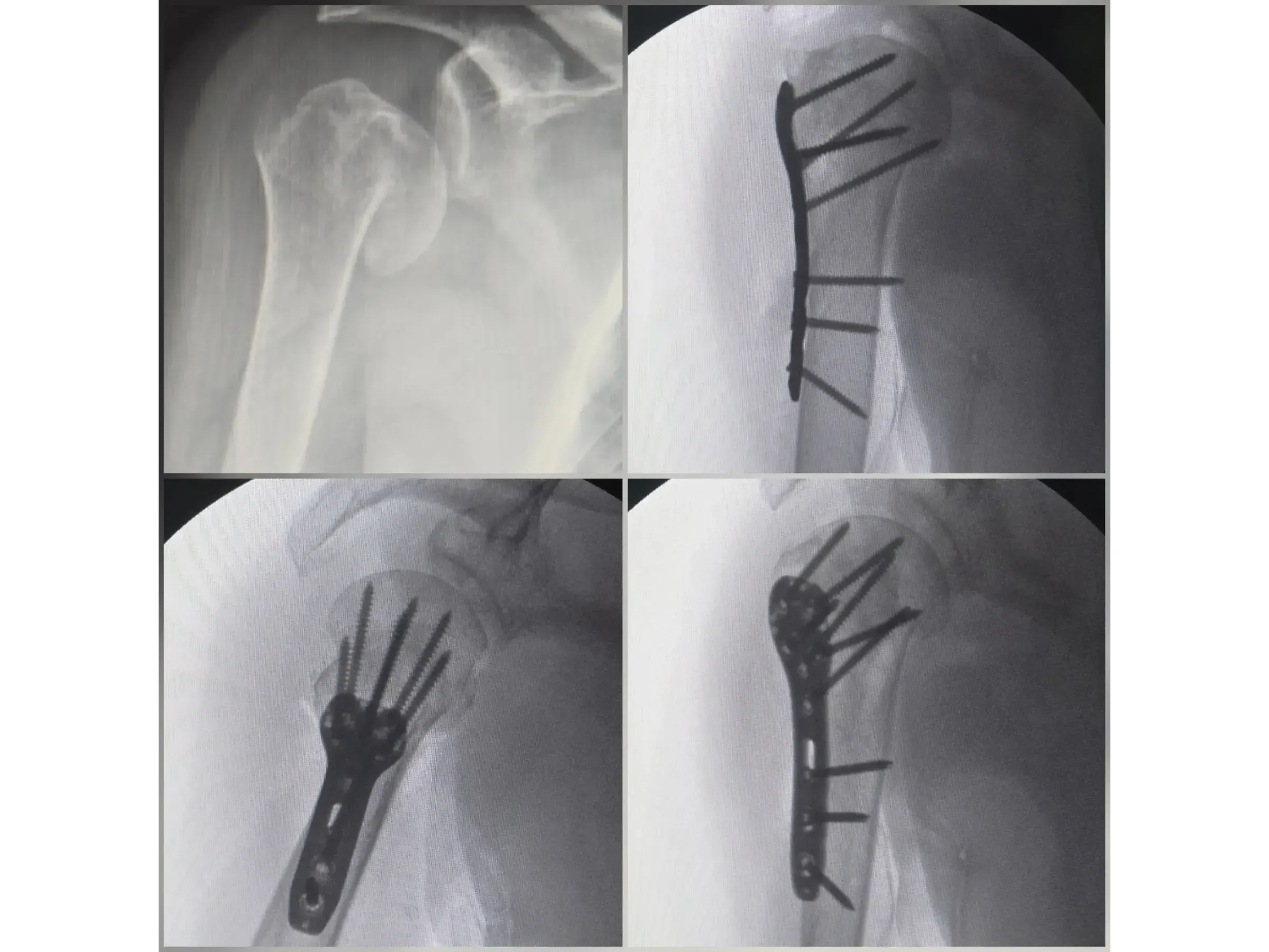 PROXIMAL HUMERUS [Case 6] · Two-Part Fracture · Plate and Screws