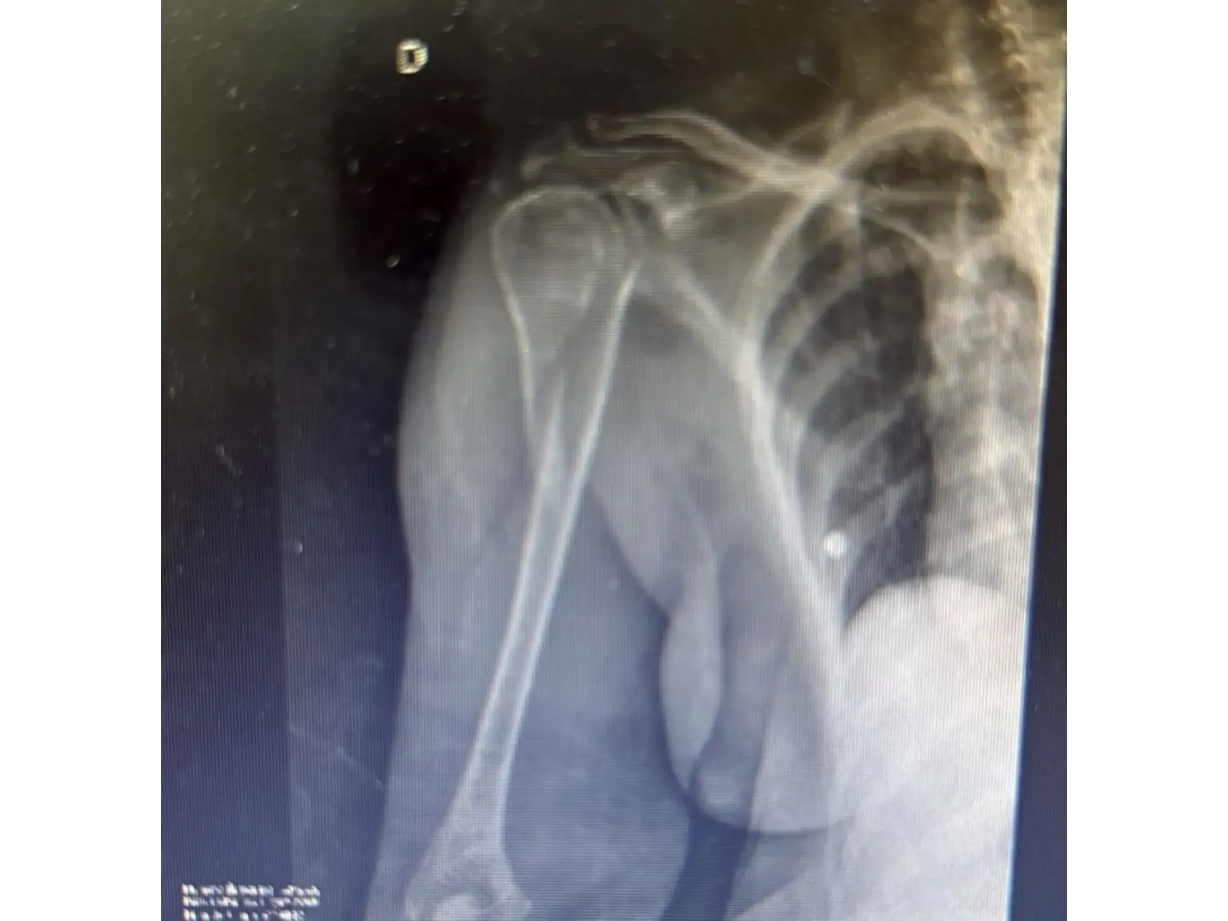 Intramedullärer Nagel für den proximalen Humerus (03)